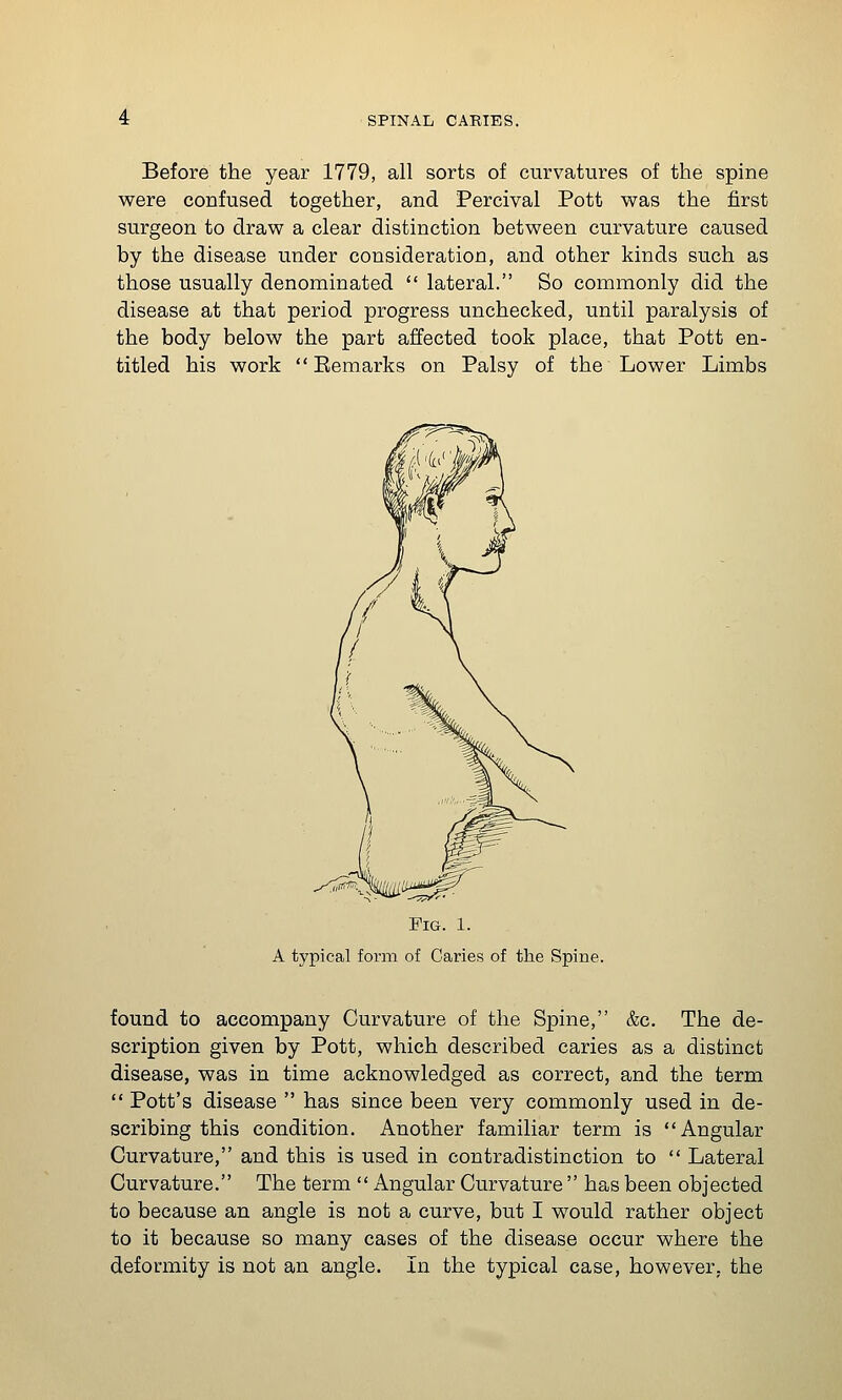 Before the year 1779, all sorts of curvatures of the spine were confused together, and Percival Pott was the first surgeon to draw a clear distinction between curvature caused by the disease under consideration, and other kinds such as those usually denominated  lateral. So commonly did the disease at that period progress unchecked, until paralysis of the body below the part affected took place, that Pott en- titled his work  Eemarks on Palsy of the Lower Limbs Fig. 1. A typical form of Caries of the Spine. found to accompany Curvature of the Spine, &c. The de- scription given by Pott, which described caries as a distinct disease, was in time acknowledged as correct, and the term  Pott's disease  has since been very commonly used in de- scribing this condition. Another familiar term is Angular Curvature, and this is used in contradistinction to  Lateral Curvature. The term  Angular Curvature  has been objected to because an angle is not a curve, but I would rather object to it because so many cases of the disease occur where the deformity is not an angle. In the typical case, however, the