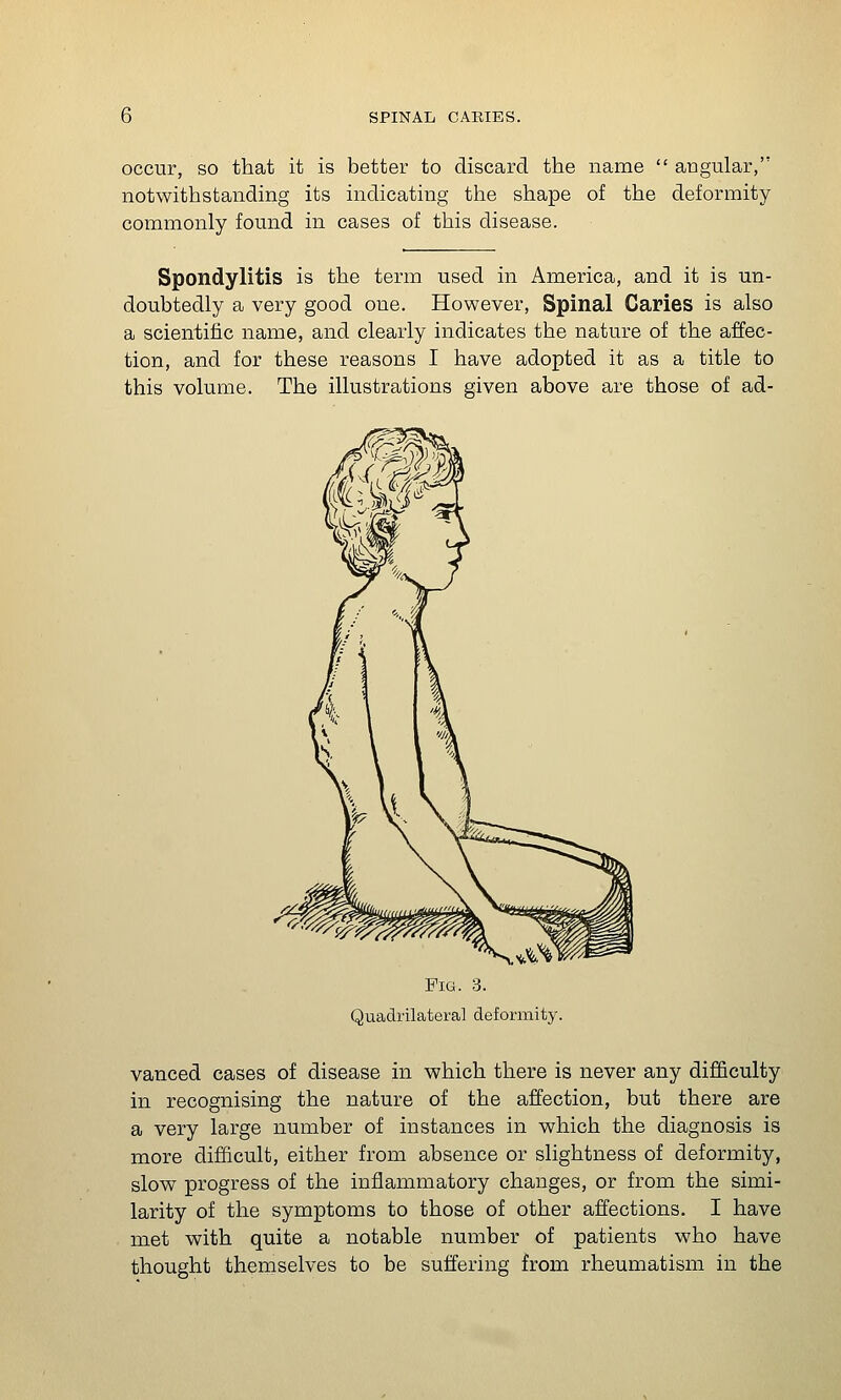 occur, SO that it is better to discard the name  angular, notwithstanding its indicating the shape of the deformity commonly found in cases of this disease. Spondylitis is the term used in America, and it is un- doubtedly a very good one. However, Spinal Caries is also a scientific name, and clearly indicates the nature of the affec- tion, and for these reasons I have adopted it as a title to this volume. The illustrations given above are those of ad- Fio. 3. Quadrilateral deformity. vanced cases of disease in which there is never any difficulty in recognising the nature of the affection, but there are a very large number of instances in which the diagnosis is more difficult, either from absence or slightness of deformity, slow progress of the inflammatory changes, or from the simi- larity of the symptoms to those of other affections. I have met with quite a notable number of patients who have thought themselves to be suffering from rheumatism in the