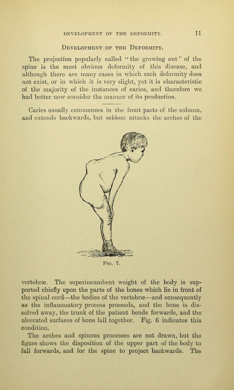 Development op the Deformity. The projection popularly called the growing out of the spine is the most obvious deformity of this disease, and although there are many cases in which such deformity does not exist, or in which it is very slight, yet it is characteristic of the majority of the instances of caries, and therefore we had better now consider the manner of its production. Caries usually commences in the front parts of the column, and extends backwards, but seldom attacks the arches of the Fig. 7. vertebrae. The superincumbent weight of the body is sup- ported chiefly upon the parts of the bones which lie in front of the spinal cord—the bodies of the vertebrae—and consequently as the inflammatory process proceeds, and the bone is dis- solved away, the trunk of the patient bends forwards, and the ulcerated surfaces of bone fall together. Fig. 6 indicates this condition. The arches and spinous processes are not drawn, but the figure shows the disposition of the upper part of the body to fall forwards, and for the spine to project backwards. The