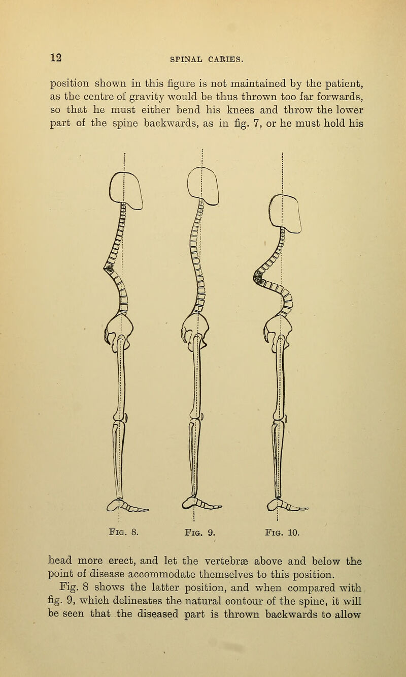 position shown in this figure is not maintained by the patient, as the centre of gravity would be thus thrown too far forwards, so that he must either bend his knees and throw the lower part of the spine backwards, as in fig. 7, or he must hold his ^' rl?< ^'' ^ Fig. Pig. 9. Fig. 10. head more erect, and let the vertebrae above and below the point of disease accommodate themselves to this position. Kg. 8 shows the latter position, and when compared with fig. 9, which delineates the natural contour of the spine, it will be seen that the diseased part is thrown backwards to allow