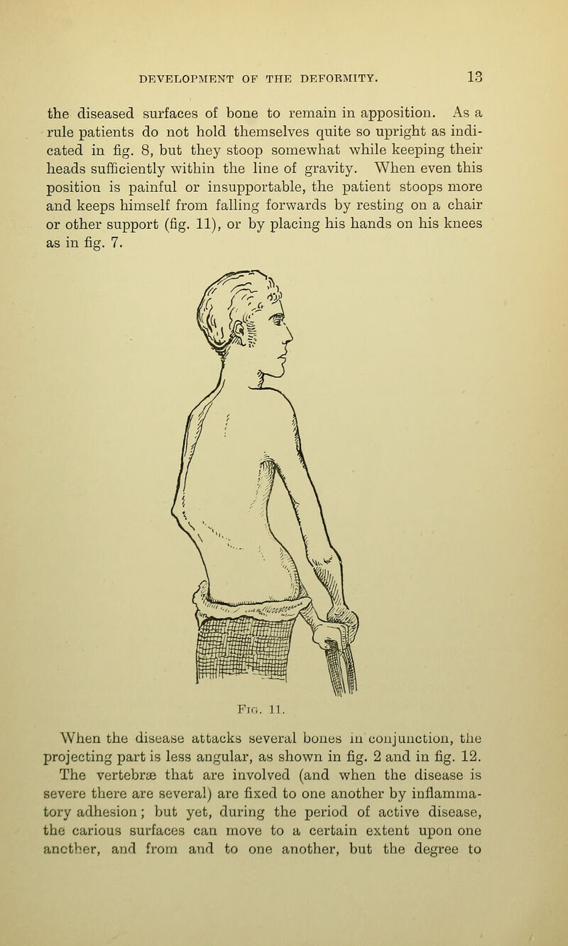 the diseased surfaces of bone to remain in apposition. As a rule patients do not hold themselves quite so upright as indi- cated in fig. 8, but they stoop somewhat while keeping their heads sufficiently within the line of gravity. When even this position is painful or insupportable, the patient stoops more and keeps himself from falling forwards by resting on a chair or other support (fig. 11), or by placing his hands on his knees as in fig. 7. When the disease attacks several bones in conjunction, the projecting part is less angular, as shown in fig. 2 and in fig. 12. The vertebrae that are involved (and when the disease is severe there are several) are fixed to one another by inflamma- tory adhesion; but yet, during the period of active disease, the carious surfaces can move to a certain extent upon one another, and from and to one another, but the degree to