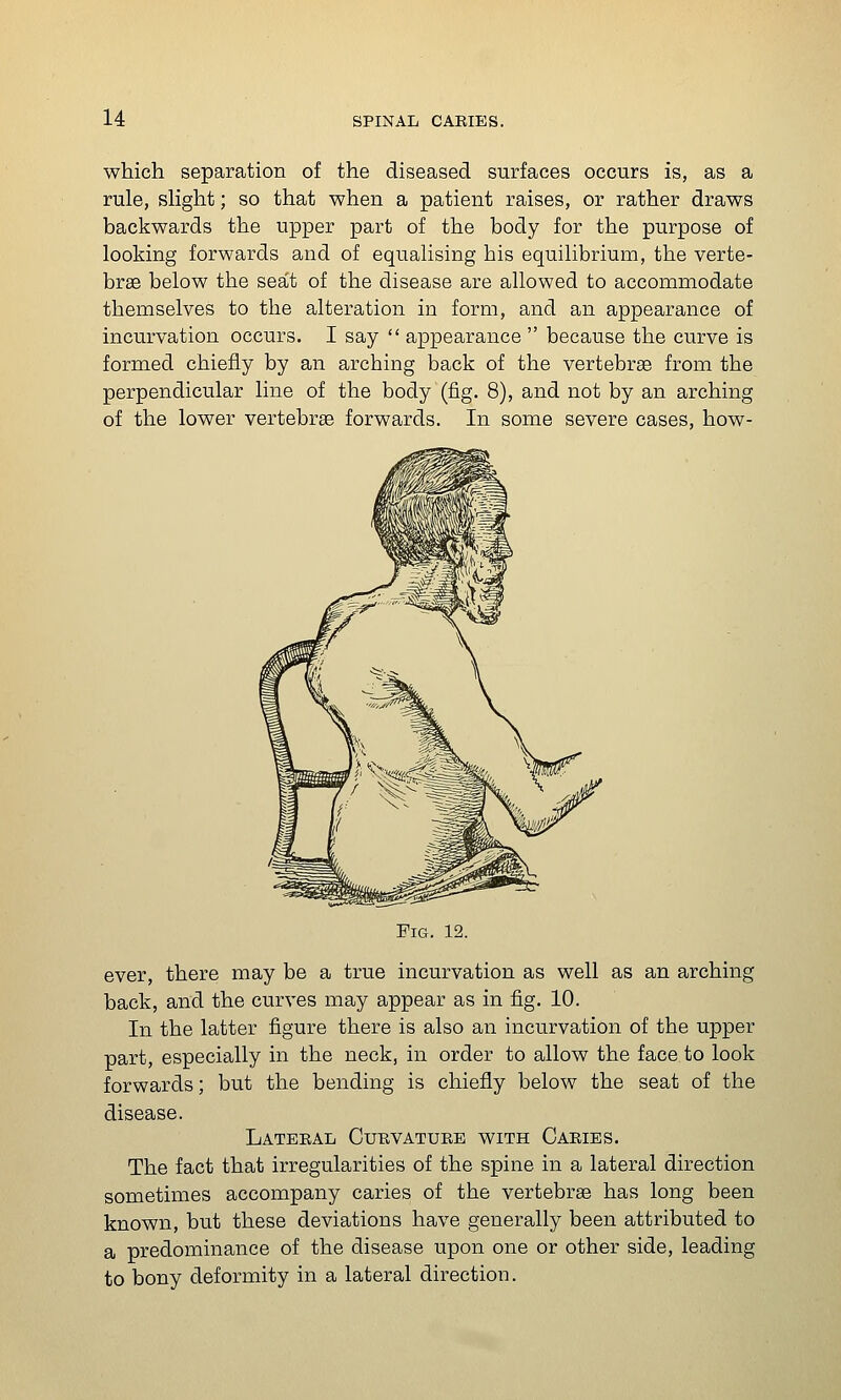 which separation of the diseased surfaces occurs is, as a rule, sHght; so that when a patient raises, or rather draws backwards the upper part of the body for the purpose of looking forwards and of equalising his equilibrium, the verte- brae below the sea't of the disease are allowed to accommodate themselves to the alteration in form, and an appearance of incurvation occurs. I say  appearance  because the curve is formed chiefly by an arching back of the vertebrae from the perpendicular line of the body (fig. 8), and not by an arching of the lower vertebrae forwards. In some severe cases, how- FiG. 12. ever, there may be a true incurvation as well as an arching back, and the curves may appear as in fig. 10. In the latter figure there is also an incurvation of the upper part, especially in the neck, in order to allow the face to look forwards; but the bending is chiefly below the seat of the disease. Lateral Curvature with Caries. The fact that irregularities of the spine in a lateral direction sometimes accompany caries of the vertebrae has long been known, but these deviations have generally been attributed to a predominance of the disease upon one or other side, leading to bony deformity in a lateral direction.