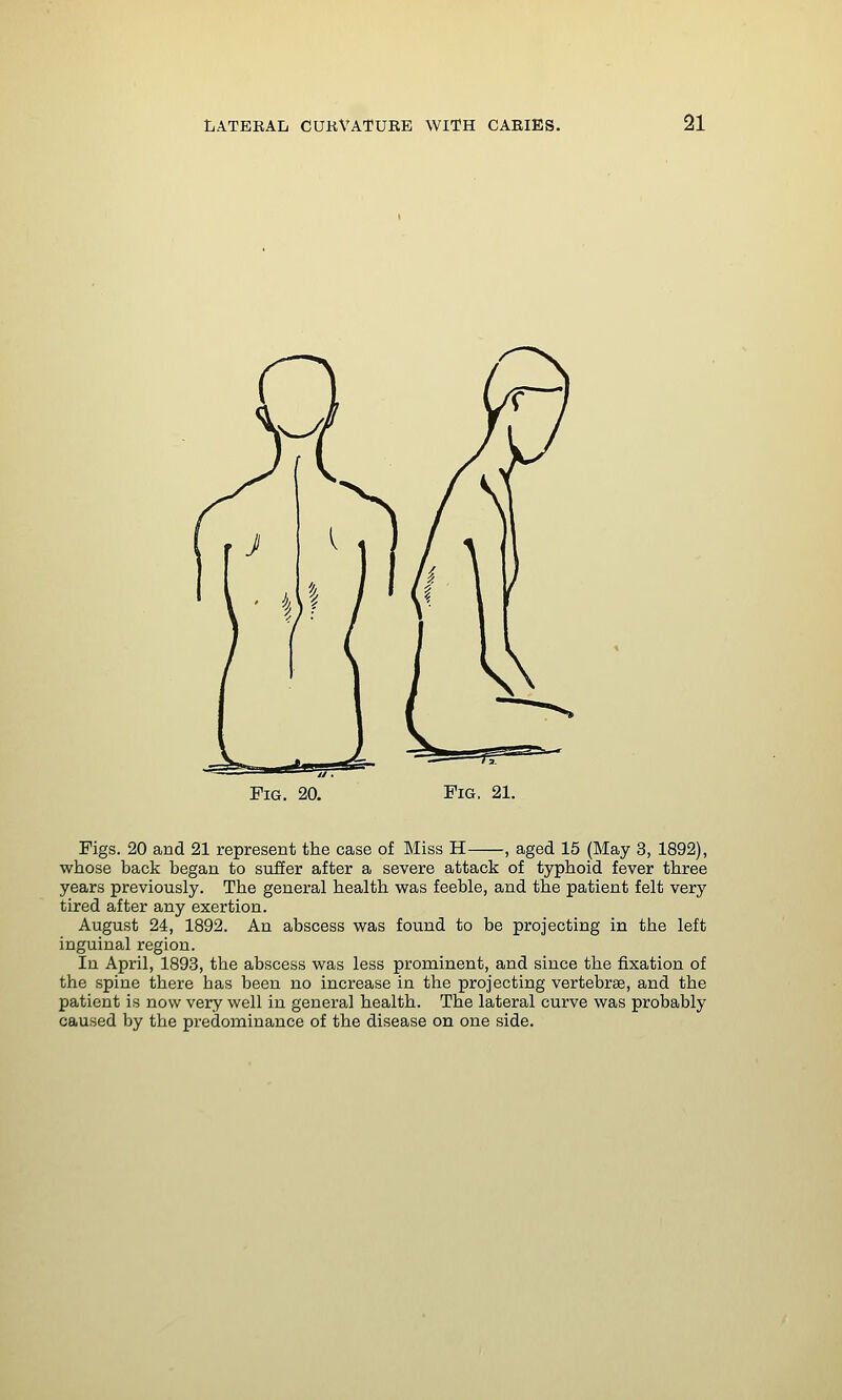 Pig. 20. Fig, 21. Figs. 20 and 21 represent the case of Miss H , aged 15 (May 3, 1892), whose back began to suffer after a severe attack of typhoid fever three years previously. The general health was feeble, and the patient felt very tired after any exertion. August 24, 1892. An abscess was found to be projecting in the left inguinal region. In April, 1893, the abscess was less prominent, and since the fixation of the spine there has been no increase in the projecting vertebrae, and the patient is now very well in general health. The lateral curve was probably caused by the predominance of the disease on one side.