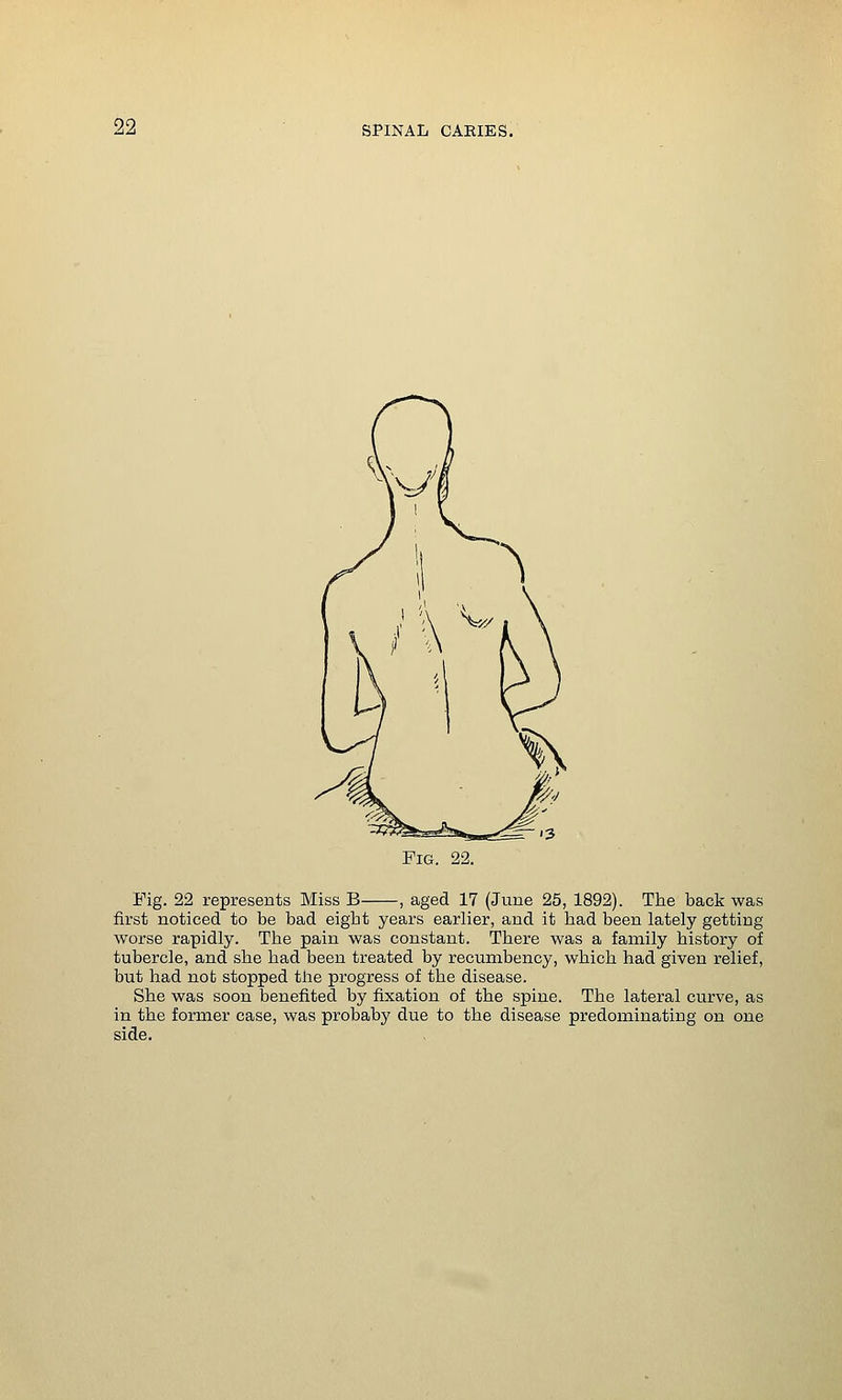 Fig. 22. Pig. 22 represents Miss B , aged 17 (June 25, 1892). The back was first noticed to be bad eight years earlier, and it had been lately getting worse rapidly. The pain was constant. There was a family history of tubercle, and she had been treated by recumbency, which had given relief, but had not stopped the progress of the disease. She was soon benefited by fixation of the spine. The lateral curve, as in the former case, was probaby due to the disease predominating on one side.