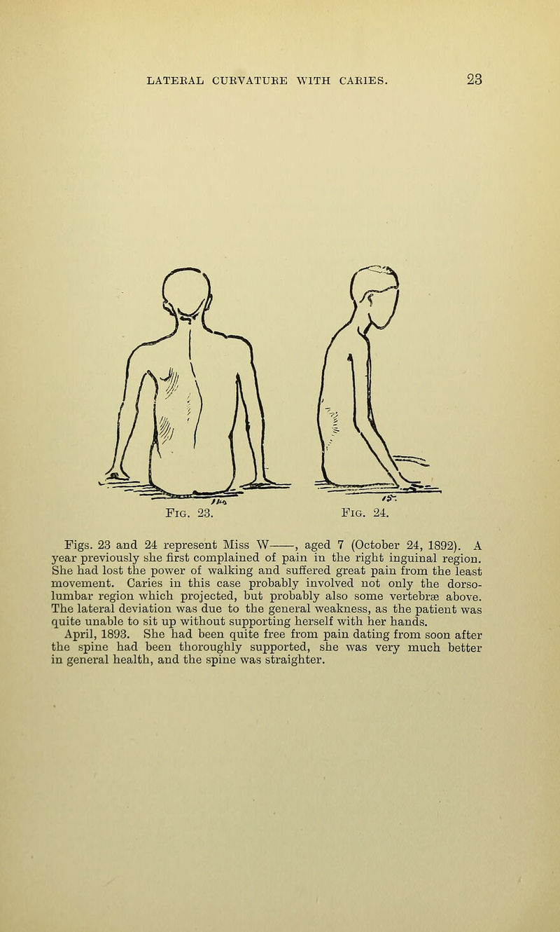 Fig. 23. Figs. 23 and 24 represent Miss W , aged 7 (October 24, 1892). A year previously she first complained of pain in the right inguinal region. She had lost the power of walking and suffered great pain from the least movement. Caries in this case probably involved not only the dorso- lumbar region which projected, but probably also some vertebrse above. The lateral deviation was due to the general weakness, as the patient was quite unable to sit up without supporting herself with her hands. April, 1893. She had been quite free from pain dating from soon after the spine had been thoroughly supported, she was very much better in general health, and the spine was straighter.