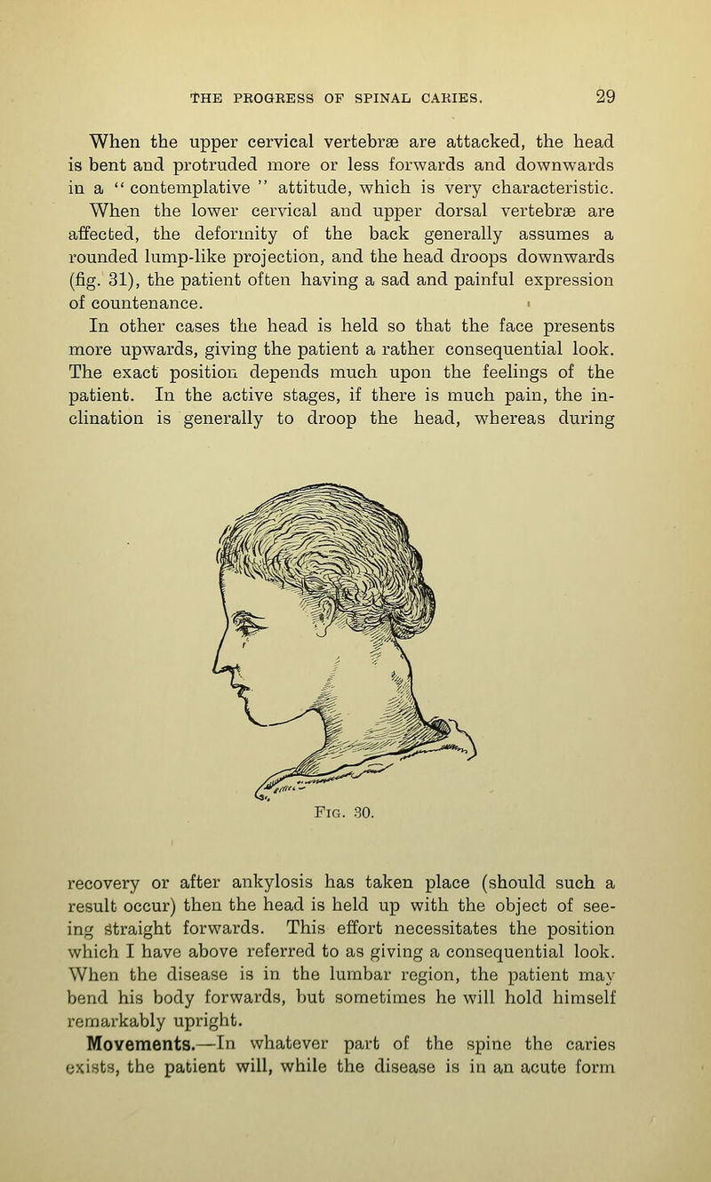 When the upper cervical vertebrae are attacked, the head is bent and protruded more or less forwards and downwards in a  contemplative  attitude, which is very characteristic. When the lower cervical and upper dorsal vertebrae are affected, the deformity of the back generally assumes a rounded lump-like projection, and the head droops downwards (fig. 31), the patient often having a sad and painful expression of countenance. In other cases the head is held so that the face presents more upwards, giving the patient a rather consequential look. The exact position depends much upon the feelings of the patient. In the active stages, if there is much pain, the in- clination is generally to droop the head, whereas during Fig. .30. recovery or after ankylosis has taken place (should such a result occur) then the head is held up with the object of see- ing Straight forwards. This effort necessitates the position which I have above referred to as giving a consequential look. When the disease is in the lumbar region, the patient may bend his body forwards, but sometimes he will hold himself remarkably upright. Movements.—In whatever part of the spine the caries exists, the patient will, while the disease is in an acute form