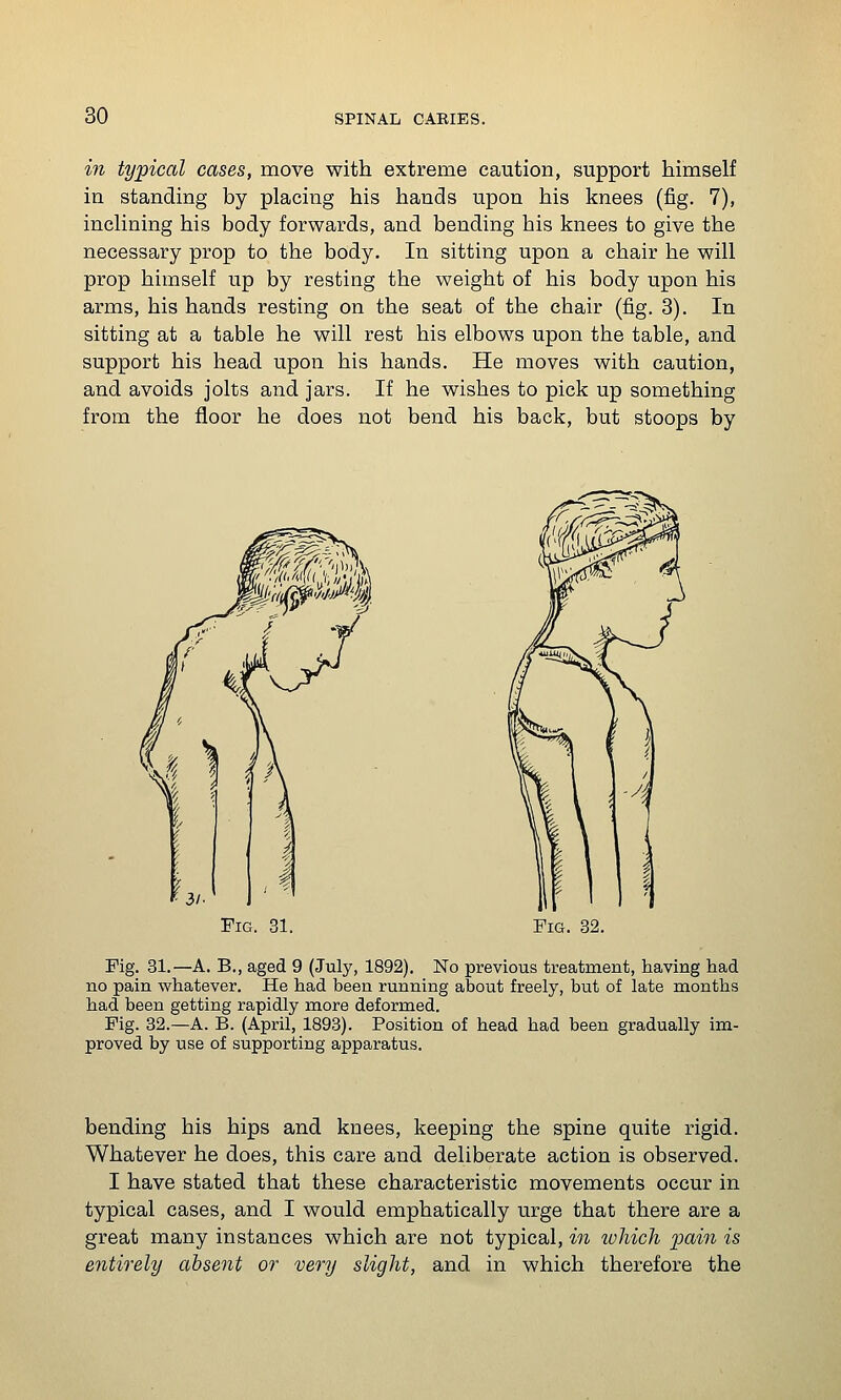 in typical cases, move with extreme caution, support himself in standing by placing his hands upon his knees (fig. 7), inclining his body forwards, and bending his knees to give the necessary prop to the body. In sitting upon a chair he will prop himself up by resting the weight of his body upon his arms, his hands resting on the seat of the chair (fig. 3). In sitting at a table he will rest his elbows upon the table, and support his head upon his hands. He moves with caution, and avoids jolts and jars. If he wishes to pick up something from the floor he does not bend his back, but stoops by Fig. 31. Fig. 32. Fig. 31.—A. B., aged 9 (July, 1892). No previous treatment, having had no pain whatever. He had been running about freely, but of late months had been getting rapidly more deformed. Fig. 82.—A. B. (April, 1893). Position of head had been gradually im- proved by use of supporting apparatus. bending his hips and knees, keeping the spine quite rigid. Whatever he does, this care and deliberate action is observed. I have stated that these characteristic movements occur in typical cases, and I would emphatically urge that there are a great many instances which are not typical, in which pain is entirely absent or very slight, and in which therefore the