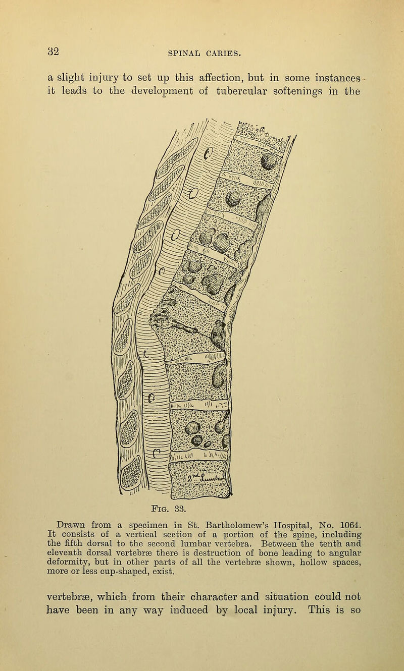 a slight injury to set up this affection, but in some instances it leads to the development of tubercular softenings in the Fig. 33. Drawn from a specimen in St. Bartholome-w's Hospital, No. 1064. It consists of a vertical section of a portion of the spine, including the fifth dorsal to the second lumbar vertebra. Between the tenth and eleventh dorsal vertebrae there is destruction of bone leading to angular deformity, but in other parts of all the vertebrae shown, hollow spaces, more or less cup-shaped, exist. vertebrae, which from their character and situation could not have been in any v^ay induced by local injury. This is so