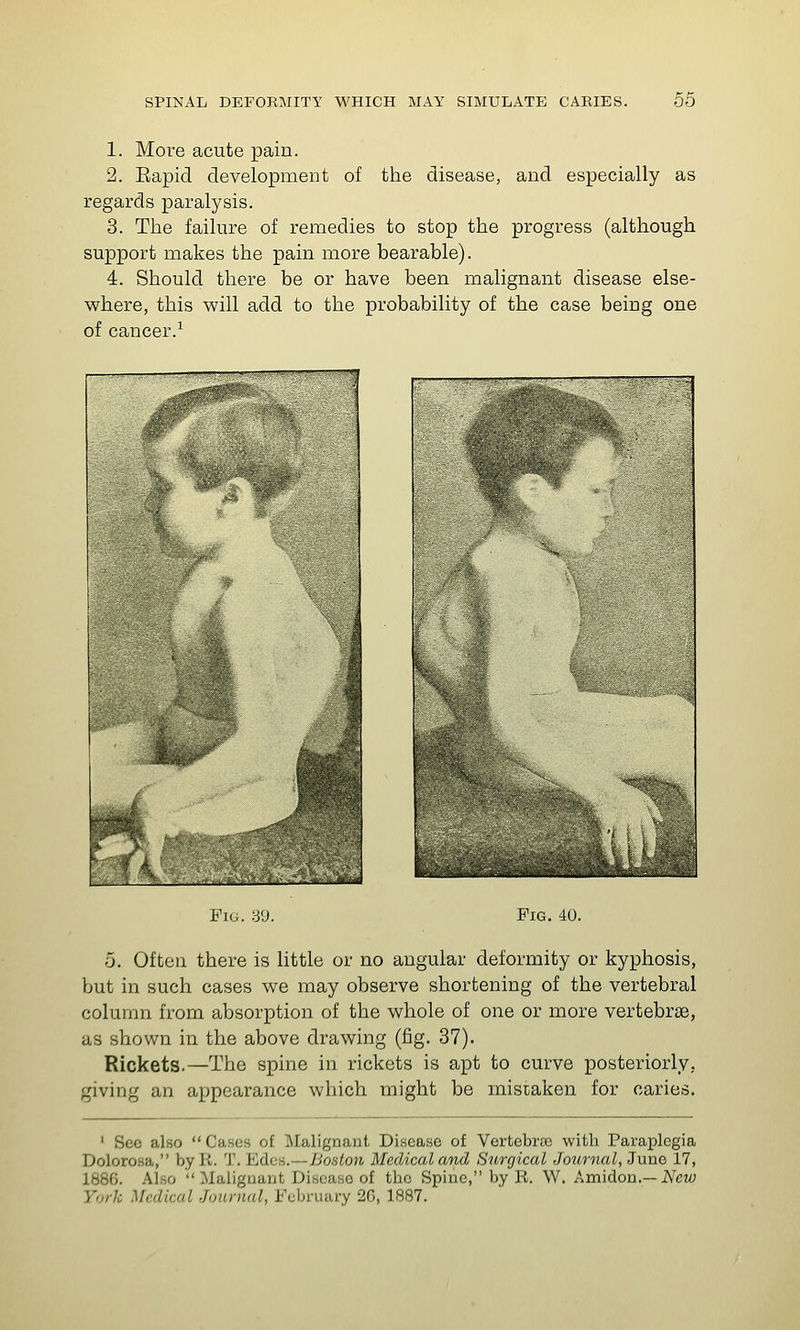 1. More acute pain. 2. Eapid development of the disease, and especially as regards paralysis. 3. The failure of remedies to stop the progress (although support makes the pain more bearable). 4. Should there be or have been malignant disease else- where, this will add to the probability of the case being one of cancer.^ Fuj. 3'J. Fig. 40. o. Often there is httle or no angular deformity or kyphosis, but in such cases we may observe shortening of the vertebral column from absorption of the whole of one or more vertebrse, as shown in the above drawing (fig. 37). Rickets.—The spine in rickets is apt to curve posteriorly, giving an appearance which might be mistaken for caries. ' Sec also  Cases of Malignant Disease of Vertebrre with Paraplegia Dolorosa, by K. T. Edcs.—Boston Medical and Surgical Journal, Juno 17, 1886. Also  Malignant Disease of the Spine, by K. W. Amidon.—i^^ew York Medical Journal, Fcln-uary 26, 1887.