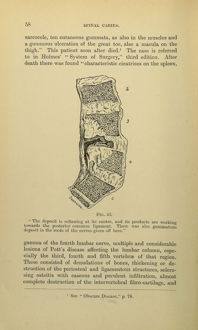 sarcocele, ten cutaneous gummata, as also in the muscles and a gummous ulceration of the great toe, also a macula on the thigh. This patient soon after died/ The case is referred to in Holmes'  System of Surgery, third edition. After death there was found characteristic cicatrices on the spleen, Fig. 43.-  The deposit is softening at its centre, and its products are working towards the posterior common ligament. There was also gummatous deposit in the roots of the nerves given off here. gumma of the fourth lumbar nerve, multiple and considerable lesions of Pott's disease affecting the lumbar column, espe- cially the third, fourth and fifth vertebrae of that region. These consisted of denudations of bones, thickening or de- struction of the periosteal and ligamentous structures, sclero- sing osteitis with caseous and purulent infiltration, almost complete destruction of the intervertebral fibro-cartilage, and ' See  Obscure Disease, p. 78.