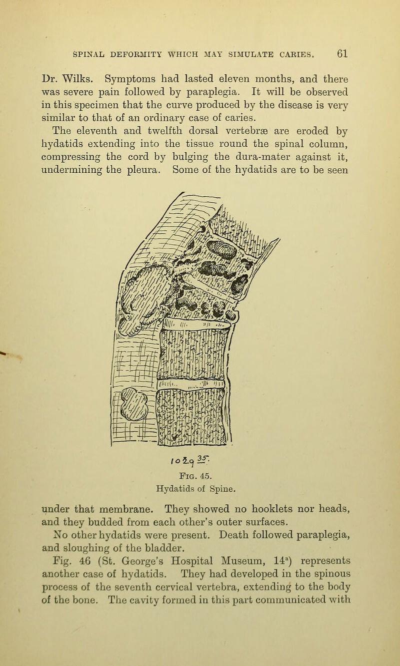 Dr. Wilks. Symptoms had lasted eleven months, and there was severe pain followed by paraplegia. It will be observed in this specimen that the curve produced by the disease is very similar to that of an ordinary case of caries. The eleventh and twelfth dorsal vertebrae are eroded by hydatids extending into the tissue round the spinal column, compressing the cord by bulging the dura-mater against it, undermining the pleura. Some of the hydatids are to be seen Fig.45. Hydatids of Spine. under that membrane. They showed no booklets nor heads, and they budded from each other's outer surfaces. No other hydatids were present. Death followed paraplegia, and sloughing of the bladder. Fig. 46 (St. George's Hospital Museum, li'') represents another case of hydatids. They had developed in the spinous process of the seventh cervical vertebra, extending to the body of the bone. The cavity formed in this part communicated with