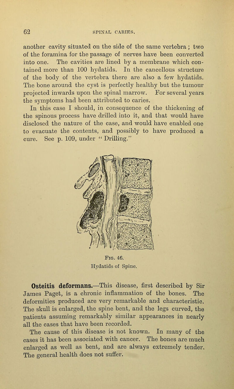 another cavity situated on the side of the same vertebra ; two of the foramina for the passage of nerves have been converted into one. The cavities are Hned by a membrane which con- tained more than 100 hydatids. In the cancellous structure of the body of the vertebra there are also a few hydatids. The bone around the cyst is perfectly healthy but the tumour projected inwards upon the spinal marrow. For several years the symptoms had been attributed to caries. In this case I should, in consequence of the thickening of the spinous process have drilled into it, and that would have disclosed the nature of the case, and would have enabled one to evacuate the contents, and possibly to have produced a cure. See p. 109, under ' Drilling. Fig. 46. Hydatids of Spine. Osteitis deformans.—This disease, first described by Sir James Paget, is a chronic inflammation of the bones. The deformities produced are very remarkable and characteristic. The skull is enlarged, the spine bent, and the legs curved, the patients assuming remarkably similar appearances in nearly all the cases that have been recorded. The cause of this disease is not known. In many of the cases it has been associated with cancer. The bones are much enlarged as well as bent, and are always extremely tender. The general health does not suffer.