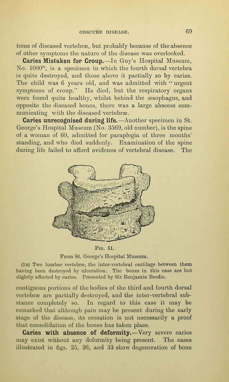 toms of diseased vertebrae, but probably because of the absence of other symptoms the nature of the disease was overlooked. Caries Mistaken for Croup.—In Guy's Hospital Museum, No. 1080^, is a specimen in which the fourth dorsal vertebra is quite destroyed, and those above it partially so by caries. The child was 6 years old, and was admitted with  urgent symptoms of croup. He died, but the respiratory organs were found quite healthy, whilst behind the oesophagus, and opposite the diseased bones, there was a large abscess com- municating with the diseased vertebrae. Caries unrecognised during life.—Another specimen in St. George's Hospital Museum (No. 3569, old number), is the spine of a woman of 60, admitted for paraplegia of three months' standing, and who died suddenly. Examination of the spine during life failed to afford evidence of vertebral disease. The Fig. 51. From St. George's Hospital Museum. (1b) Two lumbar verfcebrse, the inter-vertebral cartilage between them having been destroyed by ulceration. The bones in this case are but slightly affected by caries. Presented by Sir Benjamin Brodie. contiguous portions of the bodies of the third and fourth dorsal vertebrae are partially destroyed, and the inter-vertebral sub- stance completely so. In regard to this case it may be remarked that although pain may be present during the early stage of the disease, its cessation is not necessarily a proof that consolidation of the bones has taken place. Caries with absence of deformity.—Very severe caries may exist without any deformity being present. The cases illustrated in figs. 25, 26, and 33 show degeneration of bone