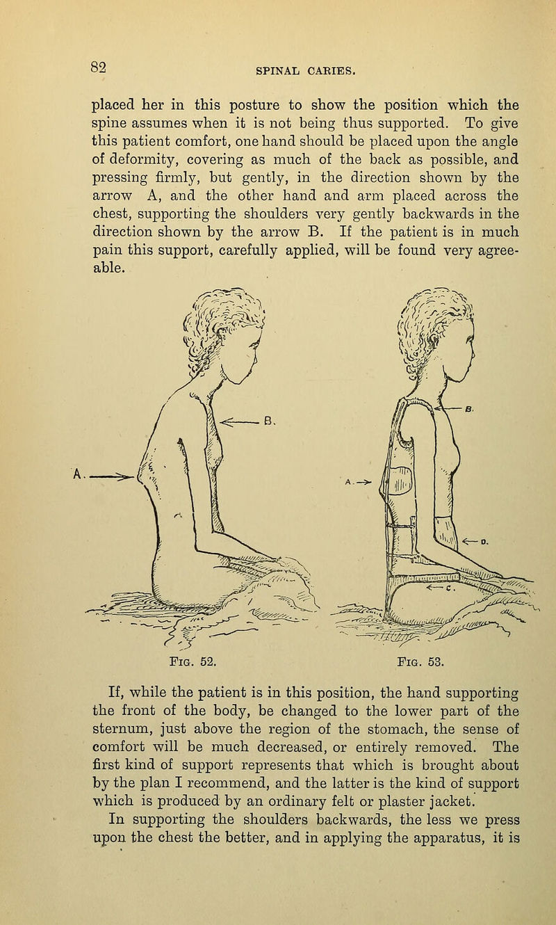 placed her in this posture to show the position which the spine assumes when it is not being thus supported. To give this patient comfort, one hand should be placed upon the angle of deformity, covering as much of the back as possible, and pressing firmly, but gently, in the direction shown by the arrow A, and the other hand and arm placed across the chest, supporting the shoulders very gently backwards in the direction shown by the arrow B. If the patient is in much pain this support, carefully applied, will be found very agree- able. If, while the patient is in this position, the hand supporting the front of the body, be changed to the lower part of the sternum, just above the region of the stomach, the sense of comfort will be much decreased, or entirely removed. The first kind of support represents that which is brought about by the plan I recommend, and the latter is the kind of support which is produced by an ordinary felt or plaster jacket. In supporting the shoulders backwards, the less we press upon the chest the better, and in applying the apparatus, it is