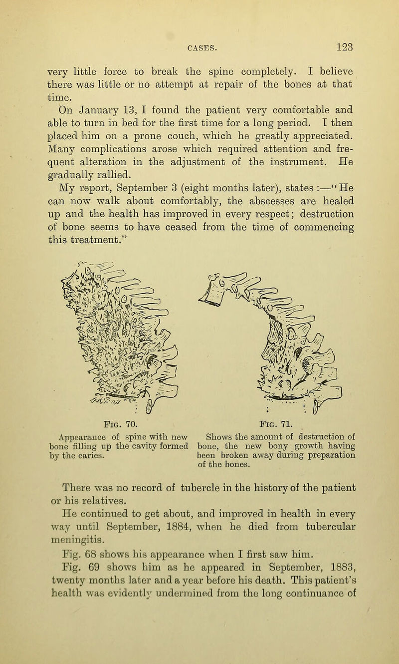 very little force to break the spine completely. I believe there was little or no attempt at repair of the bones at that time. On January 13, I found the patient very comfortable and able to turn in bed for the first time for a long period. T then placed him on a prone couch, which he greatly appreciated. Many complications arose which required attention and fre- quent alteration in the adjustment of the instrument. He gradually rallied. My report, September 3 (eight months later), states :—He can now walk about comfortably, the abscesses are healed up and the health has improved in every respect; destruction of bone seems to have ceased from the time of commencing this treatment. Pig. 70. Fig. 71. Appearance of spine with new Shows the amount of destruction of bone filling up the cavity formed bone, the new bony growth having by the caries. been broken away during preparation of the bones. There was no record of tubercle in the history of the patient or his relatives. He continued to get about, and improved in health in every way until September, 1884, when he died from tubercular meningitis. Fig. 68 shows his appearance when I first saw him. Fig. 69 shows him as he appeared in September, 1883, twenty months later and a year before his death. This patient's health was evidently undermined from the long continuance of
