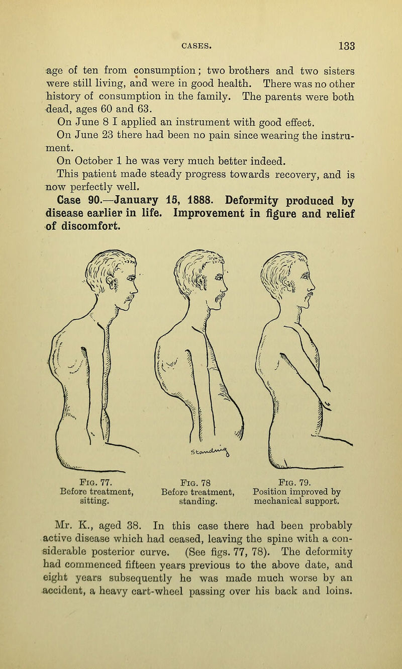 age of ten from consumption; two brothers and two sisters were still living, and were in good health. There was no other history of consumption in the family. The parents were both •dead, ages 60 and 63. On June 8 I applied an instrument with good effect. On June 23 there had been no pain since wearing the instru- ment. On October 1 he was very much better indeed. This patient made steady progress towards recovery, and is now perfectly well. Case 90.—January 15, 1888. Deformity produced by disease earlier in life. ImproYement in figure and relief of discomfort. Pig. 77. Before treatment, sitting. Fig. 78 Before treatment, standing. Fig. 79. Position improved by mechanical support. Mr. K., aged 38. In this case there had been probably active disease which had ceased, leaving the spine with a con- siderable posterior curve. (See figs. 77, 78). The deformity had commenced fifteen years previous to the above date, and eight years subsequently he was made much worse by an ■accident, a heavy cart-wheel passing over his back and loins.