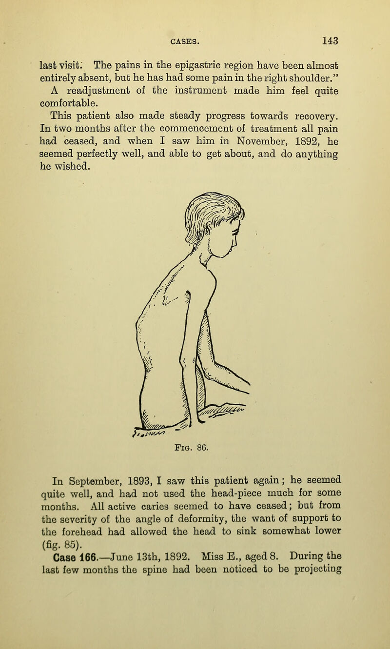 last visit.' The pains in the epigastric region have been almost entirely absent, but he has had some pain in the right shoulder. A readjustment of the instrument made him feel quite comfortable. This patient also made steady progress towards recovery. In two months after the commencement of treatment all pain had ceased, and when I saw him in November, 1892, he seemed perfectly well, and able to get about, and do anything he wished. Fig. 86. In September, 1893, I saw this patient again; he seemed quite well, and had not used the head-piece much for some months. All active caries seemed to have ceased; but from the severity of the angle of deformity, the want of support to the forehead had allowed the head to sink somewhat lower (fig. 85). Case 166.—June 13th, 1892. Miss E., aged 8. During the last few months the spine had been noticed to be projecting