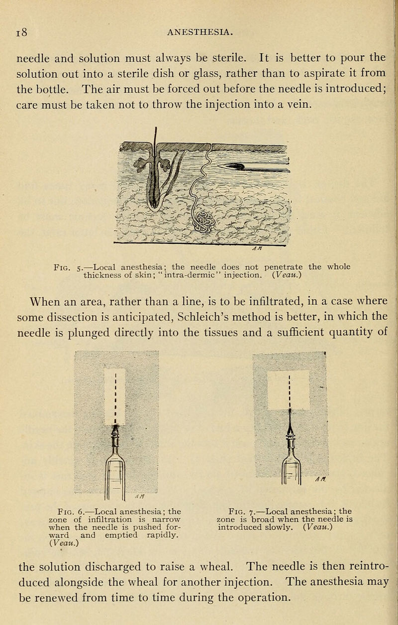 needle and solution must always be sterile. It is better to pour the solution out into a sterile dish or glass, rather than to aspirate it from the bottle. The air must be forced out before the needle is introduced; care must be taken not to throw the injection into a vein. Fig. 5.—Local anesthesia; the needle does not penetrate the whole thickness of skin;  intra -dermic  injection. (Veau.) When an area, rather than a line, is to be infiltrated, in a case where some dissection is anticipated, Schleich's method is better, in which the needle is plunged directly into the tissues and a sufficient quantity of Fig. 6.—Local anesthesia; the zone of infiltration is narrow when the needle is pushed for- ward and emptied rapidly. (Veau.) Fig. 7.—Local anesthesia; the zone is broad when the needle is introduced slowly. (Veau.) the solution discharged to raise a wheal. The needle is then reintro- duced alongside the wheal for another injection. The anesthesia may be renewed from time to time during the operation.