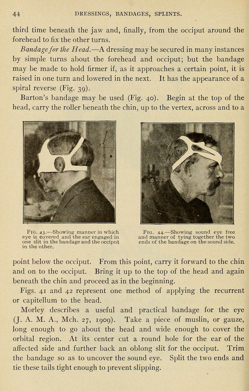 third time beneath the jaw and, finally, from the occiput around the forehead to fix the other turns. Bandage for the Head.—A dressing may be secured in many instances by simple turns about the forehead and occiput; but the bandage may be made to hold firmer if, as it approaches a certain point, it is raised in one turn and lowered in the next. It has the appearance of a spiral reverse (Fig. 39). Barton's bandage may be used (Fig. 40). Begin at the top of the head, carry the roller beneath the chin, up to the vertex, across and to a yL ' # - it /SSrt Fig. 43.—Showing manner in which eye is covered and the ear engaged in one slit in the bandage and the occiput in the other. Fig. 44.—Showing sound eye free and manner of tying together the two ends of the bandage on the sound side. point below the occiput. From this point, carry it forward to the chin and on to the occiput. Bring it up to the top of the head and again beneath the chin and proceed as in the beginning. Figs. 41 and 42 represent one method of applying the recurrent or capitellum to the head. Morley describes a useful and practical bandage for the eye (J. A. M. A., Mch. 27, 1909). Take a piece of muslin, or gauze, long enough to go about the head and wide enough to cover the orbital region. At its center cut a round hole for the ear of the affected side and further back an oblong slit for the occiput. Trim the bandage so as to uncover the sound eye. Split the two ends and tie these tails tight enough to prevent slipping.