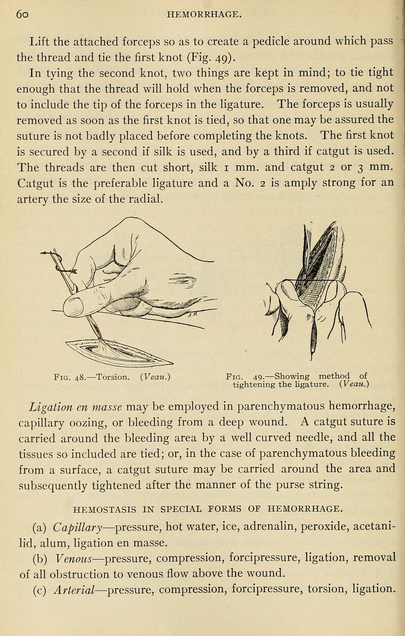 Lift the attached forceps so as to create a pedicle around which pass the thread and tie the first knot (Fig. 49). In tying the second knot, two things are kept in mind; to tie tight enough that the thread will hold when the forceps is removed, and not to include the tip of the forceps in the ligature. The forceps is usually removed as soon as the first knot is tied, so that one may be assured the suture is not badly placed before completing the knots. The first knot is secured by a second if silk is used, and by a third if catgut is used. The threads are then cut short, silk 1 mm. and catgut 2 or 3 mm. Catgut is the preferable ligature and a No. 2 is amply strong for an artery the size of the radial. Fig. 48.—Torsion. (Veau.) Fig. 49.—Showing method of tightening the ligature. (Veau.) Ligation en masse may be employed in parenchymatous hemorrhage, capillary oozing, or bleeding from a deep wound. A catgut suture is carried around the bleeding area by a well curved needle, and all the tissues so included are tied; or, in the case of parenchymatous bleeding from a surface, a catgut suture may be carried around the area and subsequently tightened after the manner of the purse string. HEMOSTASIS IN SPECIAL FORMS OF HEMORRHAGE. (a) Capillary—pressure, hot water, ice, adrenalin, peroxide, acetani- lid, alum, ligation en masse. (b) Venous—pressure, compression, forcipressure, ligation, removal of all obstruction to venous flow above the wound. (c) Arterial—pressure, compression, forcipressure, torsion, ligation.