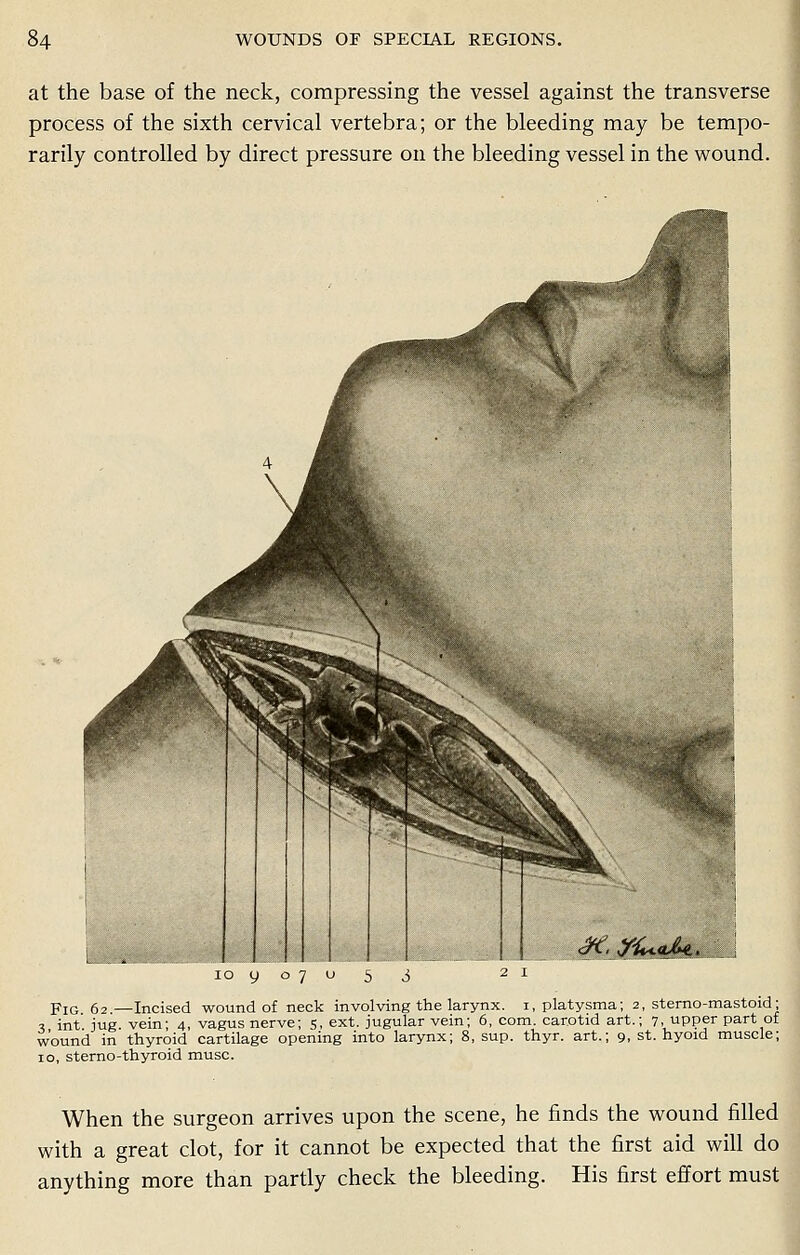 at the base of the neck, compressing the vessel against the transverse process of the sixth cervical vertebra; or the bleeding may be tempo- rarily controlled by direct pressure on the bleeding vessel in the wound. &. Yi«*Mt pIG 62 —Incised wound of neck involving the larynx. 1, platysma; 2, sterno-mastoid; x int jug vein- 4, vagus nerve; 5, ext. jugular vein; 6, com. carotid art.; 7. upper part of wound in thyroid cartilage opening into larynx; 8, sup. thyr. art.; 9, st. hyoid muscle; 10, sterno-thyroid muse. When the surgeon arrives upon the scene, he finds the wound filled with a great clot, for it cannot be expected that the first aid will do anything more than partly check the bleeding. His first effort must