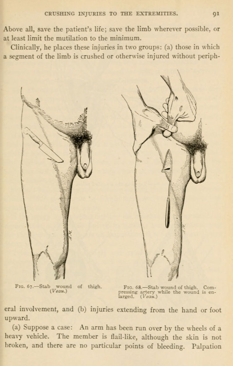 Above all, save the patient's life; save the limb wherever possible, or at least limit the mutilation to the minimum. Clinically, he places these injuries in two groups: (a) those in which a segment of the limb is crushed or otherwise injured without periph- Fig. 67 thigh. Fie. 68.—Stab wound of thigh. Com- pressing artery while the wound is en- larged. (IVjk.) eral involvement, and (b) injuries extending from the hand or foot upward. (a) Suppose a case: An arm has been run over by the wheels heavy vehicle. The member is flail-like, although the skin is not broken, and there are no particular points of bleeding. Palpation
