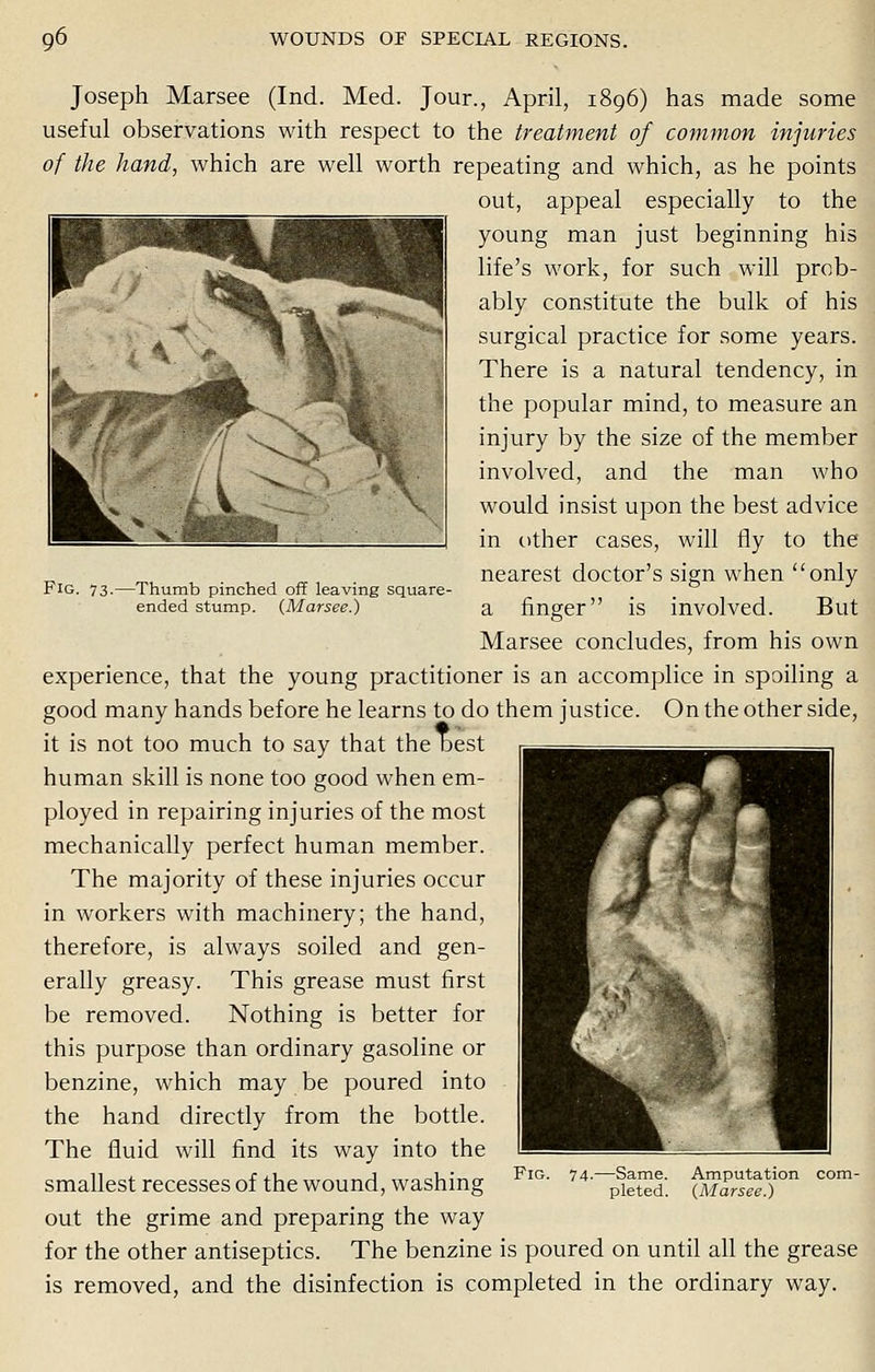 Fig. 73. -Thumb pinched off leaving square- ended stump. (Marsee.) Joseph Marsee (Ind. Med. Jour., April, 1896) has made some useful observations with respect to the treatment of common injuries of the hand, which are well worth repeating and which, as he points out, appeal especially to the young man just beginning his life's work, for such will prob- ably constitute the bulk of his surgical practice for some years. There is a natural tendency, in the popular mind, to measure an injury by the size of the member involved, and the man who would insist upon the best advice in other cases, will fly to the nearest doctor's sign when only a finger is involved. But Marsee concludes, from his own experience, that the young practitioner is an accomplice in spoiling a good many hands before he learns to do them justice. On the other side, it is not too much to say that the best human skill is none too good when em- ployed in repairing injuries of the most mechanically perfect human member. The majority of these injuries occur in workers with machinery; the hand, therefore, is always soiled and gen- erally greasy. This grease must first be removed. Nothing is better for this purpose than ordinary gasoline or benzine, which may be poured into the hand directly from the bottle. The fluid will find its way into the smallest recesses of the wound, washing out the grime and preparing the way for the other antiseptics. The benzine is poured on until all the grease is removed, and the disinfection is completed in the ordinary way. Fig. Amputation com- (Marsee.)