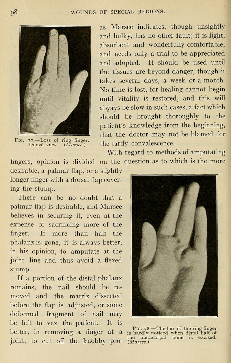 Fig. 77.—Loss of ring finger. Dorsal view. (Marsee.) as Marsee indicates, though unsightly and bulky, has no other fault; it is light, absorbent and wonderfully comfortable, and needs only a trial to be appreciated and adopted. It should be used until the tissues are beyond danger, though it takes several days, a week or a month No time is lost, for healing cannot begin until vitality is restored, and this will always be slow in such cases, a fact which should be brought thoroughly to the patient's knowledge from the beginning, that the doctor may not be blamed for the tardy convalescence. With regard to methods of amputating fingers, opinion is divided on the question as to which is the more desirable, a palmar flap, or a slightly longer finger with a dorsal flap cover- ing the stump. There can be no doubt that a palmar flap is desirable, and Marsee believes in securing it, even at the expense of sacrificing more of the finger. If more than half the phalanx is gone, it is always better, in his opinion, to amputate at the joint line and thus avoid a flexed stump. If a portion of the distal phalanx remains, the nail should be re- moved and the matrix dissected before the flap is adjusted, or some deformed fragment of nail may be left to vex the patient. It is , ., . r , Fig. 78.—The loss of the ring finger better, in removing a finger at a is hardly noticed when distal half of . . , , , n- .1 •. it the metacarpal bone is excised, joint, to cut off the knobby pro- {Marsee.)