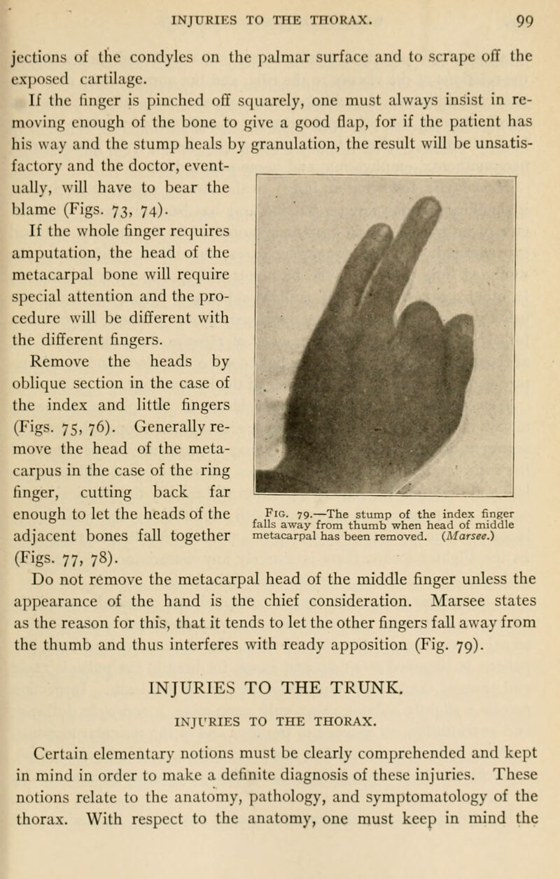 ■ ink Kirs th mi'. thorax. 99 iections of the condyles on the palmar surface and to scrape off the exposed cartilage. If the finger is pinched off squarely, one must always insist in re- moving enough of the bone to give a good flap, for if the patient has his way and the stump heals by granulation, the result will be unsatis- factory and the doctor, event- ually, will have to bear the blame (Figs. 73, 74). If the whole finger requires amputation, the head of the metacarpal bone will require special attention and the pro- cedure will be different with the different fingers. Remove the heads by oblique section in the case of the index and little fingers (Figs. 75, 76). Generally re- move the head of the meta- carpus in the case of the ring finger, cutting back far enough to let the heads of the adjacent bones fall together (Figs. 77, 78). Do not remove the metacarpal head of the middle finger unless the appearance of the hand is the chief consideration. Marsee states as the reason for this, that it tends to let the other fingers fall away from the thumb and thus interferes with ready apposition (Fig. 79). Fig. 79.—The stump of the index finger falls away from thumb when head of middle metacarpal has been removed. (Marsee.) INJURIES TO THE TRUNK. INJURIES TO THE THORAX. Certain elementary notions must be clearly comprehended and kept in mind in order to make a definite diagnosis of these injuries. These notions relate to the anatomy, pathology, and symptomatology of the thorax. With respect to the anatomy, one must keep in mind the