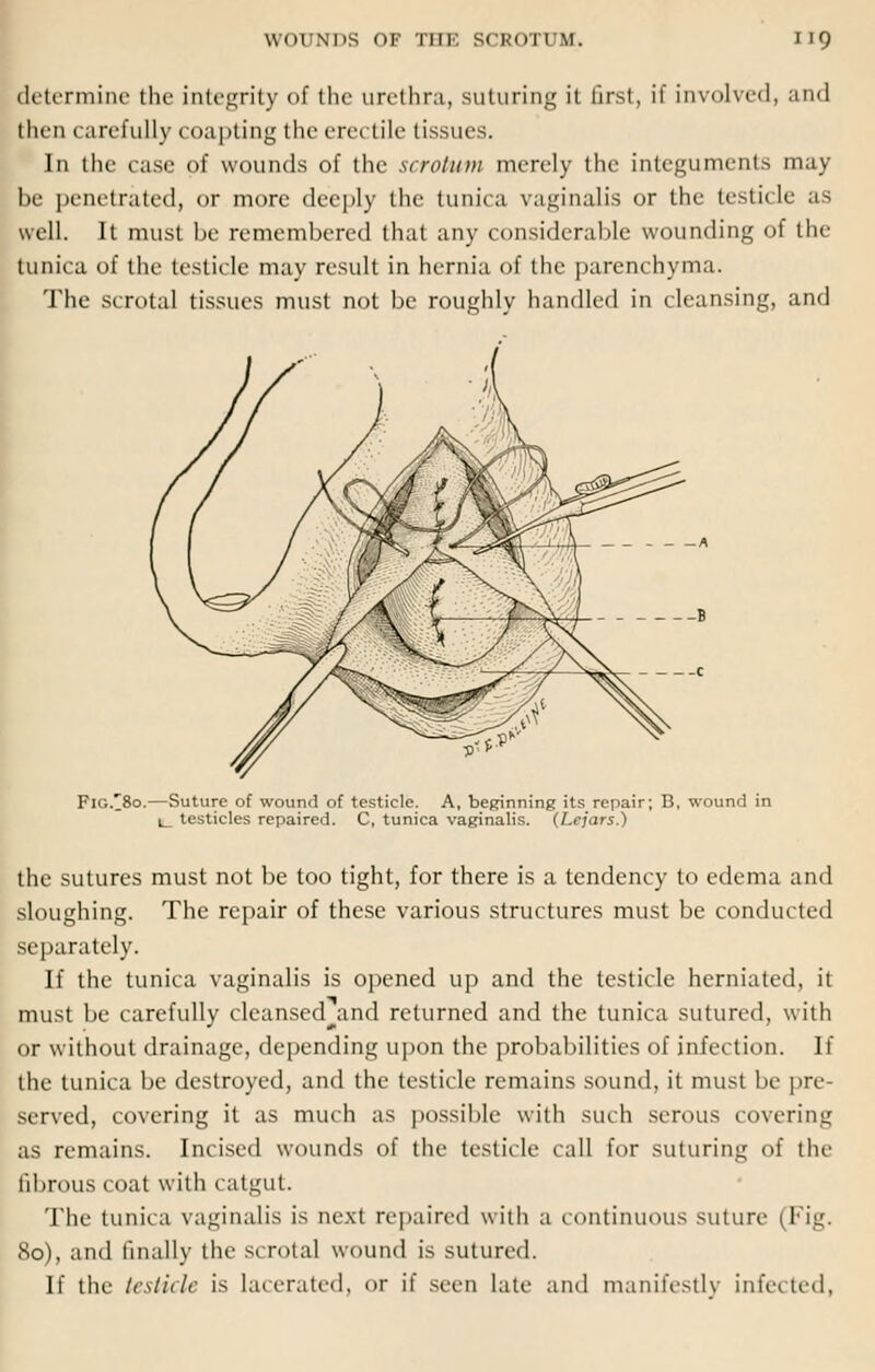 determine the integrity of the urethra, suturing it first, ii involved, and then carefull} 1 oapting the erectile tissues. In the case of wounds of the scrotum merely the integuments may be penetrated, or more deeply the tunica vaginalis or the testicle as well. It must be remembered that any considerable wounding of the tunica of the testicle may result in hernia of the parenchyma. The scrotal tissues must not be roughly handled in cleansing, and F1G.I80.—Suture of wound of testicle. A, beginning its repair; B, wound in l_ testicles repaired. C, tunica vaginalis. (Lejars.) the sutures must not be too tight, for there is a tendency to edema and sloughing. The repair of these various structures must be conducted separately. If the tunica vaginalis is opened up and the testicle herniated, it must be carefully cleansed and returned and the tunica sutured, with or without drainage, depending upon the probabilities of infection. If the tunica be destroyed, and the testicle remains sound, it must be pre- served, covering it as much as possible with such serous covering as remains. Incised wounds of the testicle call for suturing of the fibrous coat with catgut. The tunica vaginalis is next repaired with a continuous suture (Fig. 80), and finally the scrota] wound is sutured. If the testicle is lacerated, or if seen late and manifestly infected.