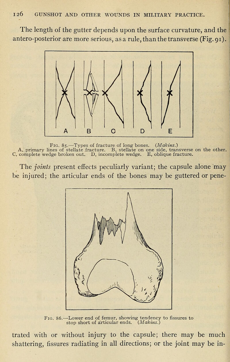 The length of the gutter depends upon the surface curvature, and the antero-posterior are more serious, as a rule, than the transverse (Fig. 91). Fig. 85.—Types of fracture of long bones. (Makins.) A* primary lines of stellate fracture. B, stellate on one side, transverse on the other. C, complete wedge broken out. D, incomplete wedge. E, oblique fracture. The joints present effects peculiarly variant; the capsule alone may be injured; the articular ends of the bones may be guttered or pene- Fig. 86.—Lower end of femur, showing tendency to fissures to stop short of articular ends. (Makins.) trated with or without injury to the capsule; there may be much shattering, fissures radiating in all directions; or the joint may be in-