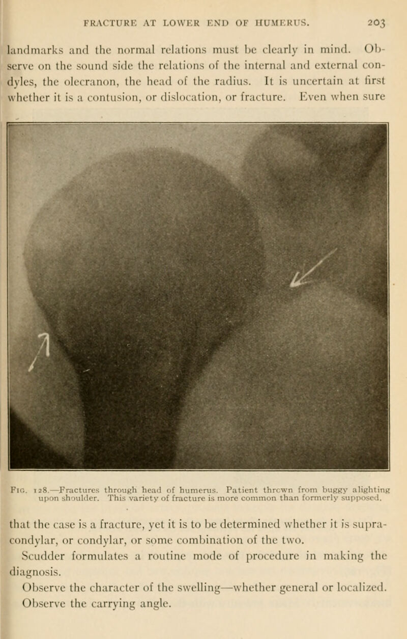 landmarks ami tin- normal relations must be clearly in mind. Ob serve on the sound side die relations <>t the interna] and external ion Byles, die olecranon, the head of the radius. It is uncertain at first whether it is a contusion, or dislocation, or fracture. Even when sure Pig. 128.—Fractures through head of humerus. Patient thrown from buggy alighting upon shoulder. This variety of fracture is mure common than formerly supposed. that the 1 ase is a fracture, yet it is to be determined whether it is supra- condylar, or ( ondylar, or some combination of the two. S. udder formulates a routine mode of procedure in making the Diagnosis. Observe the character of the swelling—whether general or Localized. Observe the carrying angle.