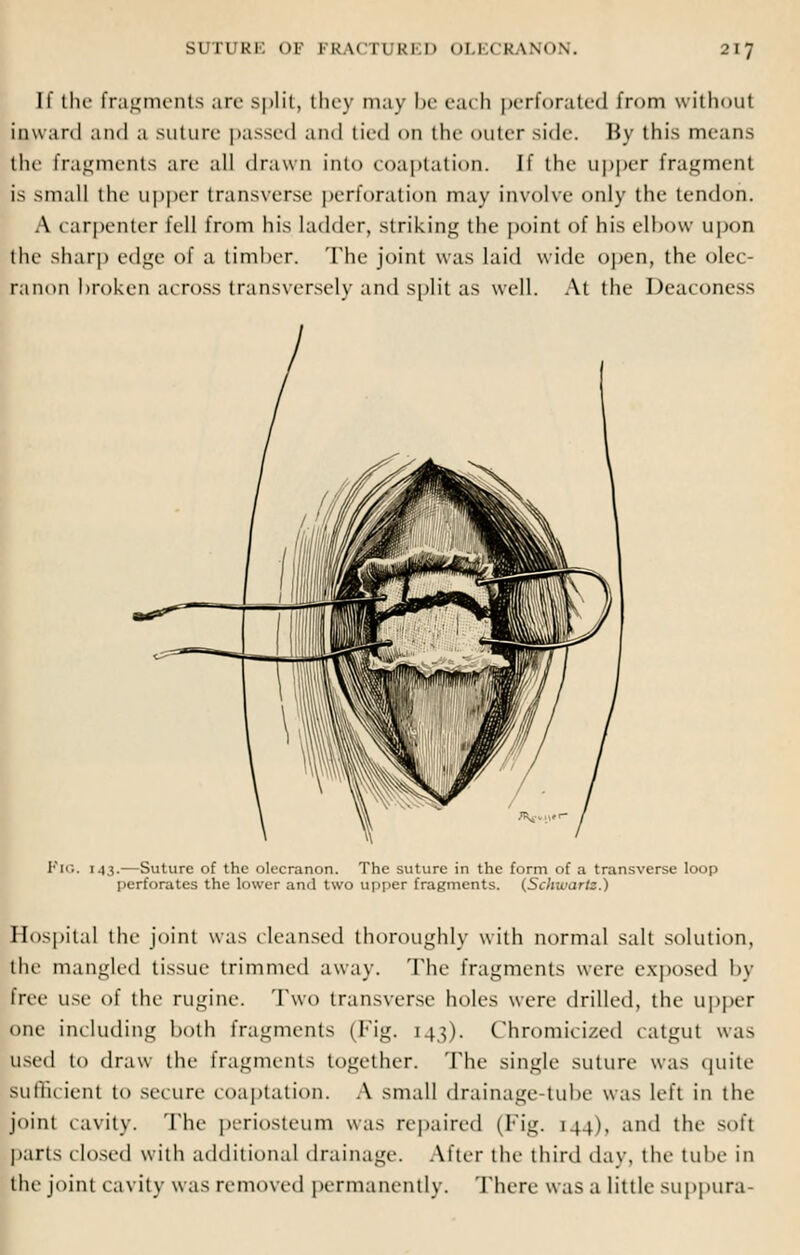 If the fragments are split, they may be eat b perforated from without inward and a suture passed and tied on tin- outer side-. By this mean-. tin1 Fragments art' all drawn into coaptation. If the upper fragment is small the upper transverse perforation may involve only tin- tendon. A carpenter fell from his ladder, striking the point of his elbow upon the -harp edge of a timber. The joint was laid wide open, the olec- ranon broken across transversely and split as well. At the Deaconess PlG. 143.—Suture of the olecranon. The suture in the form of a transverse loop perforates the lower and two upper fragments. (Schwartz.) Hospital the joint was cleansed thoroughly with normal salt solution, the mangled tissue trimmed away. The fragments were exposed by free use' of the rugine. Two transverse holes were drilled, the upper one including both fragments (Fig, [43). Chromicixed catgut was used to draw the fragments together. The single suture was quite Sufficient to secure coaptation. A small drainage-tube was left in the joint cavity. The periosteum was repaired (Fig. 144), and the soft parts closed with additional drainage. After the third day, the tube in the joint cavity was removed permanently. There w as a little suppura-