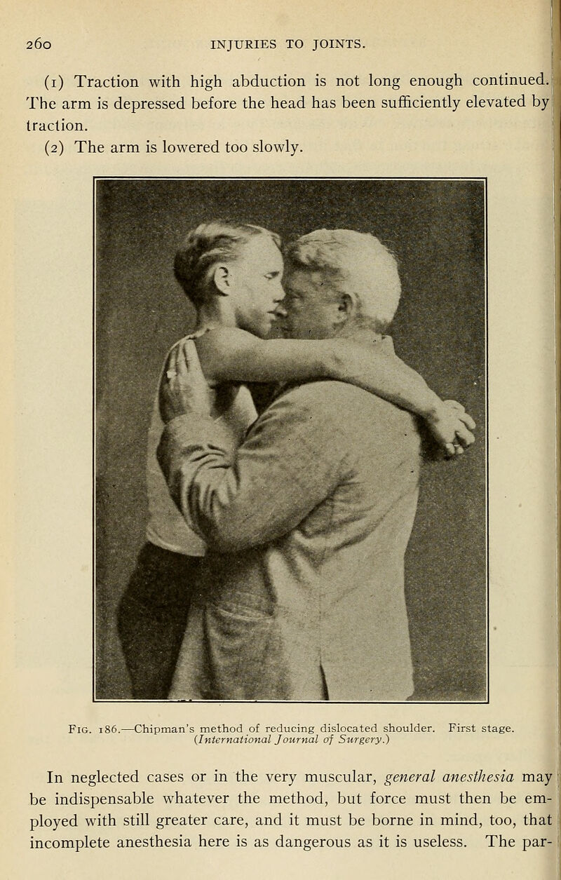 (i) Traction with high abduction is not long enough continued. The arm is depressed before the head has been sufficiently elevated by- traction. (2) The arm is lowered too slowly. Fig. 186.—Chipman's method of reducing dislocated shoulder. First stage. (International Journal of Surgery.) In neglected cases or in the very muscular, general anesthesia may be indispensable whatever the method, but force must then be em- ployed with still greater care, and it must be borne in mind, too, that incomplete anesthesia here is as dangerous as it is useless. The par-