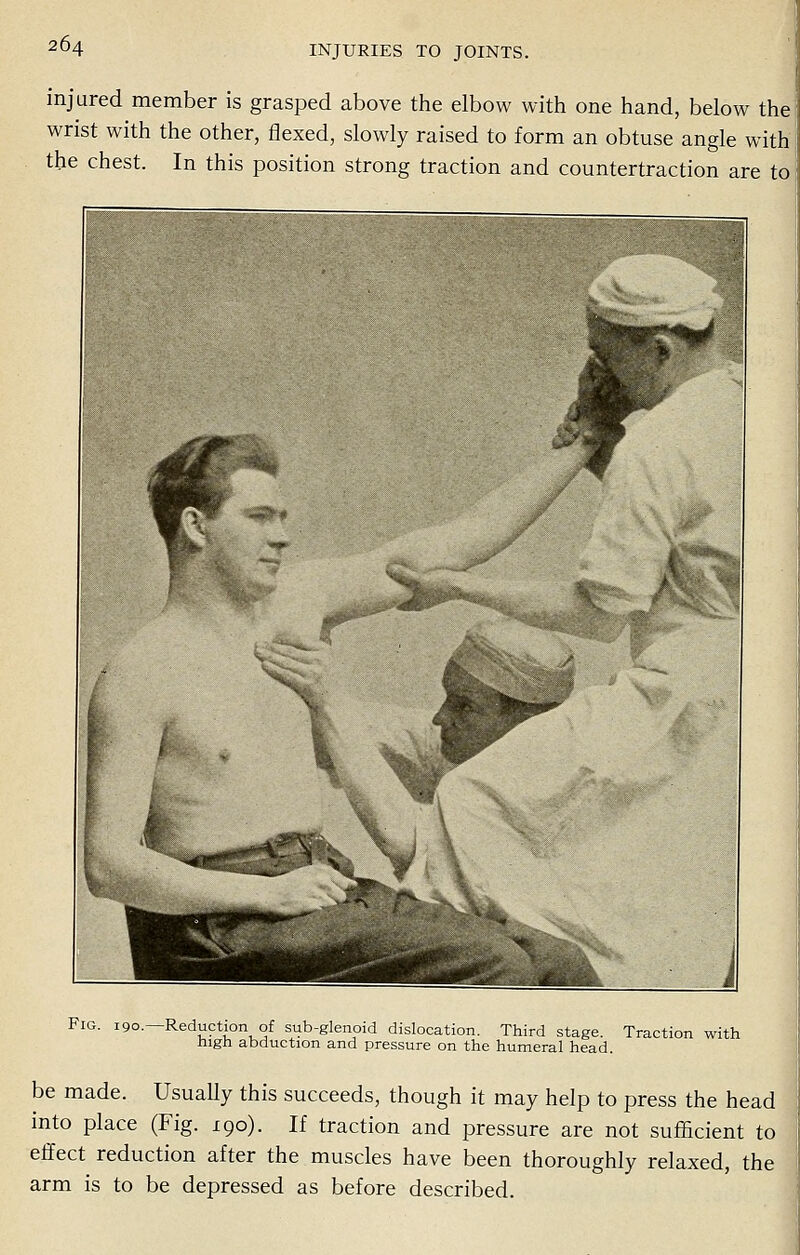 injured member is grasped above the elbow with one hand, below the wrist with the other, flexed, slowly raised to form an obtuse angle with the chest. In this position strong traction and countertraction are to Fig. 190—Reduction of sub-glenoid dislocation. Third stage. Traction with high abduction and pressure on the humeral head. be made. Usually this succeeds, though it may help to press the head into place (Fig. 190). If traction and pressure are not sufficient to effect reduction after the muscles have been thoroughly relaxed, the arm is to be depressed as before described.