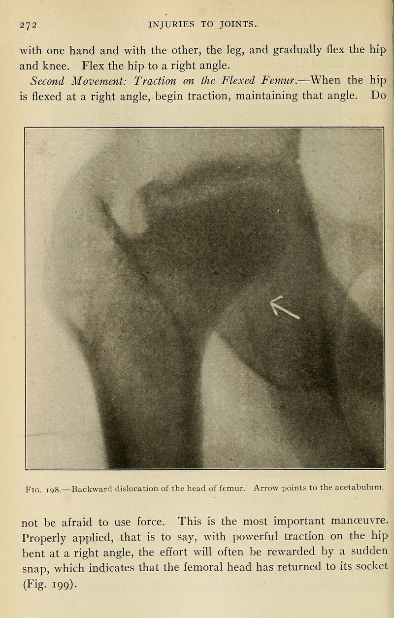 with one hand and with the other, the leg, and gradually flex the hip and knee. Flex the hip to a right angle. Second Movement: Traction on the Flexed Femur.—When the hip is flexed at a right angle, begin traction, maintaining that angle. Do Fig. 198.—Backward dislocation of the head of femur. Arrow points to the acetabulum. not be afraid to use force. This is the most important manoeuvre. Properly applied, that is to say, with powerful traction on the hip bent at a right angle, the effort will often be rewarded by a sudden snap, which indicates that the femoral head has returned to its socket (Fig. 199).