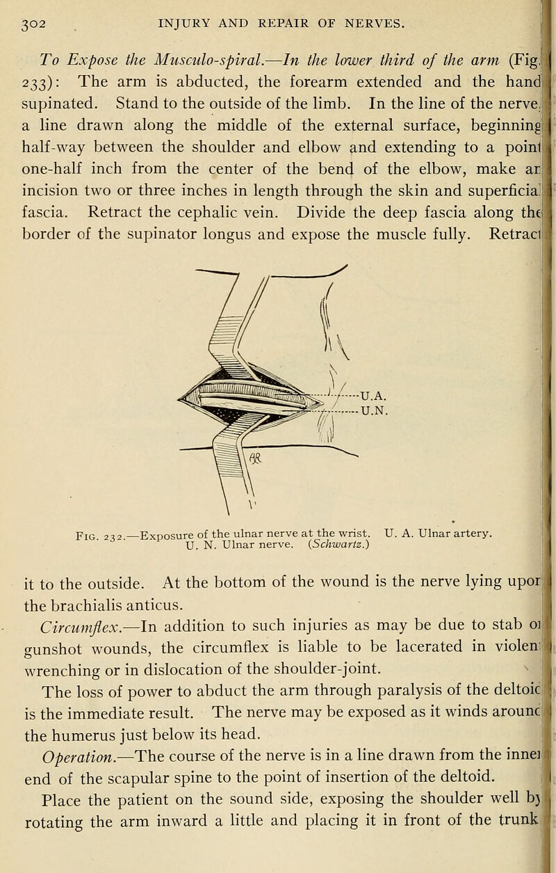 To Expose the Musculo-spiral.—In the lower third of the arm (Fig, 233): The arm is abducted, the forearm extended and the hand supinated. Stand to the outside of the limb. In the line of the nerve, a line drawn along the middle of the external surface, beginning half-way between the shoulder and elbow and extending to a poinl one-half inch from the center of the bend of the elbow, make ar incision two or three inches in length through the skin and superficia fascia. Retract the cephalic vein. Divide the deep fascia along the border of the supinator longus and expose the muscle fully. Retract pIG 232 Exposure of the ulnar nerve at the wrist. U. A. Ulnar artery. U. N. Ulnar nerve. {Schwartz.) it to the outside. At the bottom of the wound is the nerve lying upoi the brachialis anticus. Circumflex.—In addition to such injuries as may be due to stab oi gunshot wounds, the circumflex is liable to be lacerated in violen wrenching or in dislocation of the shoulder-joint. The loss of power to abduct the arm through paralysis of the deltoic is the immediate result. The nerve may be exposed as it winds arounc the humerus just below its head. Operation.—The course of the nerve is in a line drawn from the innei end of the scapular spine to the point of insertion of the deltoid. Place the patient on the sound side, exposing the shoulder well b) rotating the arm inward a little and placing it in front of the trunk