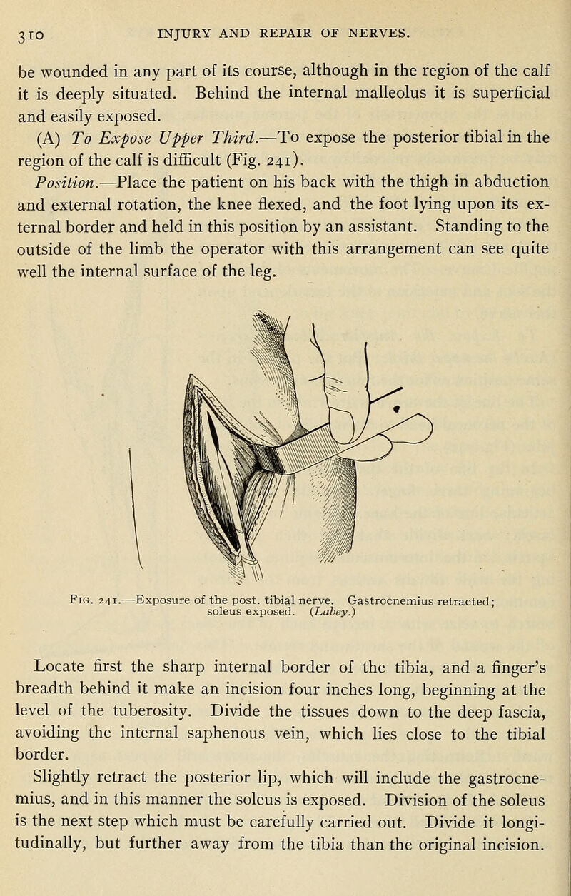 be wounded in any part of its course, although in the region of the calf it is deeply situated. Behind the internal malleolus it is superficial and easily exposed. (A) To Expose Upper Third.—To expose the posterior tibial in the region of the calf is difficult (Fig. 241). Position.—Place the patient on his back with the thigh in abduction and external rotation, the knee flexed, and the foot lying upon its ex- ternal border and held in this position by an assistant. Standing to the outside of the limb the operator with this arrangement can see quite well the internal surface of the leg. Fig. 241.—Exposure of the post, tibial nerve. Gastrocnemius retracted; soleus exposed. (Labey.) Locate first the sharp internal border of the tibia, and a finger's breadth behind it make an incision four inches long, beginning at the level of the tuberosity. Divide the tissues down to the deep fascia, avoiding the internal saphenous vein, which lies close to the tibial border. Slightly retract the posterior lip, which will include the gastrocne- mius, and in this manner the soleus is exposed. Division of the soleus is the next step which must be carefully carried out. Divide it longi- tudinally, but further away from the tibia than the original incision.