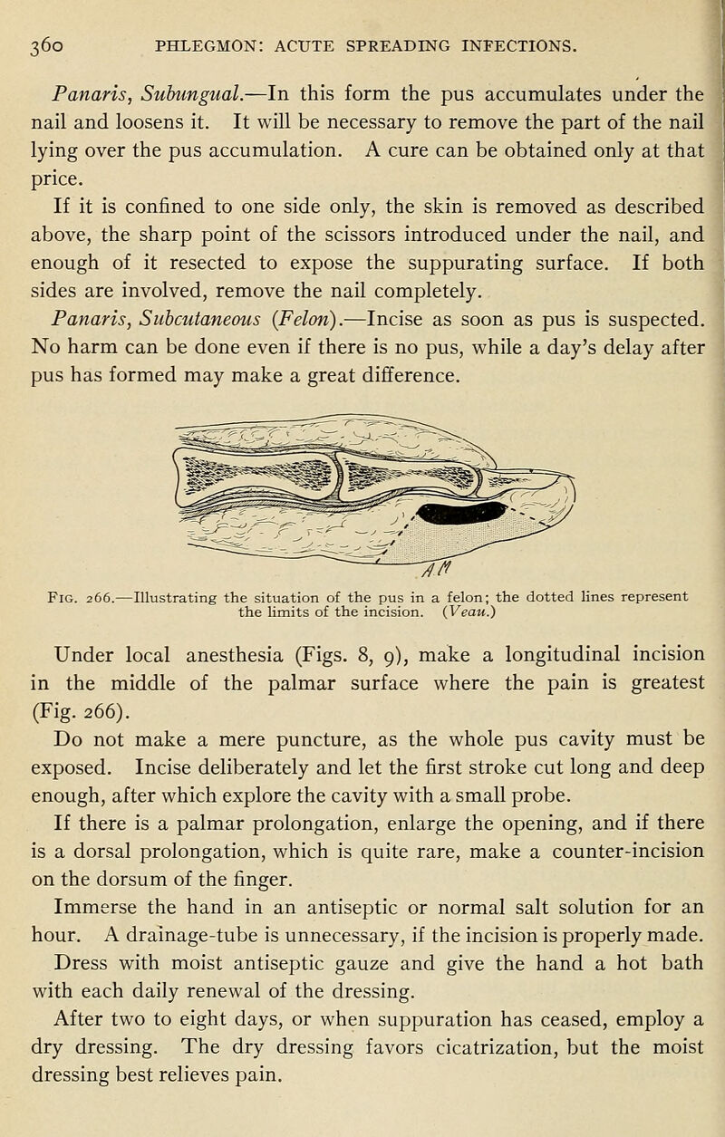 Panaris, Subungual.—In this form the pus accumulates under the nail and loosens it. It will be necessary to remove the part of the nail lying over the pus accumulation. A cure can be obtained only at that price. If it is confined to one side only, the skin is removed as described above, the sharp point of the scissors introduced under the nail, and enough of it resected to expose the suppurating surface. If both sides are involved, remove the nail completely. Panaris, Subcutaneous {Felon).—Incise as soon as pus is suspected. No harm can be done even if there is no pus, while a day's delay after pus has formed may make a great difference. Fig. 266.—Illustrating the situation of the pus in a felon; the dotted lines represent the limits of the incision. (Veau.) Under local anesthesia (Figs. 8, 9), make a longitudinal incision in the middle of the palmar surface where the pain is greatest (Fig. 266). Do not make a mere puncture, as the whole pus cavity must be exposed. Incise deliberately and let the first stroke cut long and deep enough, after which explore the cavity with a small probe. If there is a palmar prolongation, enlarge the opening, and if there is a dorsal prolongation, which is quite rare, make a counter-incision on the dorsum of the finger. Immerse the hand in an antiseptic or normal salt solution for an hour. A drainage-tube is unnecessary, if the incision is properly made. Dress with moist antiseptic gauze and give the hand a hot bath with each daily renewal of the dressing. After two to eight days, or when suppuration has ceased, employ a dry dressing. The dry dressing favors cicatrization, but the moist dressing best relieves pain.