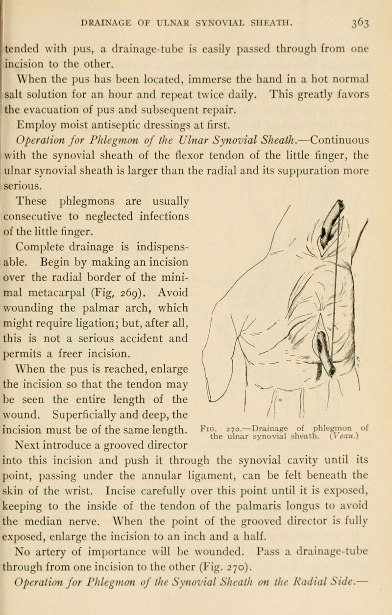 tended with pus, a drainage tube is easily passed through from one incision to the other. When the pus has been Located, immerse the hand in a hot normal salt solution for an hour and repeat twite daily. This greatly favors the evacuation of pus and subsequent repair. Employ moist antiseptic dressings at first. Operation for Phlegmon of the Ulnar Synovial Sheath.—Continuous with the synovial sheath of the flexor tendon of the little finger, the ulnar synovial sheath is larger than the radial and its suppuration more serious. These phlegmons are usually consecutive to neglected infections of the little finger. Complete drainage is indispens- able. Begin by making an incision over the radial border of the mini- mal metacarpal (Fig, 269). Avoid wounding the palmar arch, which might require ligation; but, after all, this is not a serious accident and permits a freer incision. When the pus is reached, enlarge the incision so that the tendon may be seen the entire length of the wound. Superficially and deep, the incision must be of the same length. Next introduce a grooved director into this incision and push it through the synovial cavity until its point, passing under the annular ligament, can be felt beneath the skin of the wrist. Incise carefully over this point until it is exposed, keeping to the inside of the tendon of the palmaris longus to avoid the median nerve. When the point of the grooved director is fully exposed, enlarge the incision to an inch and a half. No artery of importance will be wounded. Pass a drainage-tube through from one incision to the other (Fig. 270). Operation for Phlegmon of the Synovial Sheath on the Radial Side.— Fir,. 270.—Drainage of phlegmon of the ulnar synovial sheath. (V«aw.)