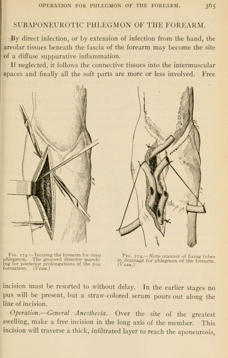 SUBAPONEUR* ►TIC PHLEGMON OF THE FOREARM. By direct infection, <>r by extension of infection from the hand, the areolar tissues beneath tin- fascia of the forearm may become the site of a diffuse suppurative inflammation. If neglected, it follows the connective tissues into the intermuscular Spaces and finally all the soft parts are more or less involved. Free PlG. 273.—Incising the forearm for phlegmon. The grooved director search- ing for posterior prolongations of the pus formation. (Veou.) Fig. 274.— Note manner of fixing tubes in drainage for phlegmon of the forearm. ( 1 t'iIK.1 incision must he resorted to without delay. In the earlier stages no pus will he present, hut a straw-colored serum pours out along the line of incision. Operation —General Anesthesia. Over the site of the greatest swelling, make a free incision in the long axis of the member. This incision will traverse a thick, infiltrated layer to reach the aponeurosis,