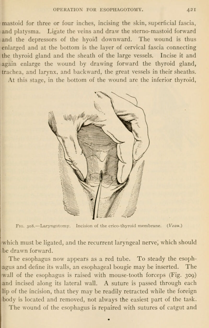 «>l-i km |.in i OH l SOPHAGOTOMY. .).' i mastoid for three or four inches, incising the skin, superficial fascia, and platysma. Ligate the veins and draw the sterno mastoid forward and the depressors of the byoid downward. The wound is thus enlarged and at the bottom is the layer of cervical fascia connecting the thyroid gland and the sheath of the large vessels. Incise it and again enlarge the wound by drawing forward the thyroid gland, trachea, and larynx, and backward, the greal vessels in their sheaths. At this stage, in the bottom of the wound are the inferior thyroid. Fig. 308.—Laryngotomy. Incision of the crico-thyroid membrane. (Veau.) which must be ligated, and the recurrent laryngeal nerve, which should he drawn forward. The esophagus now appears as a red tube. To steady the esoph- agus and define iis walls, an esophageal bougie may be inserted. The wall of the esophagus is raised with mouse-tooth forceps (Fig. 309) and incised along its lateral wall. A suture is passed through each li]> of the inri^ion, that they may he readily retracted while the foreign body i> located and removed, not always the easiest part of the task. The wound of the esophagus is repaired with sutures of catgut and