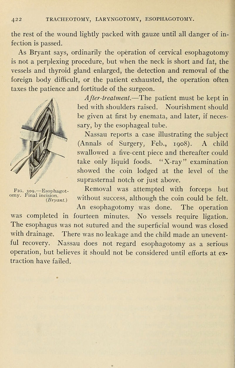 the rest of the wound lightly packed with gauze until all danger of in- fection is passed. As Bryant says, ordinarily the operation of cervical esophagotomy is not a perplexing procedure, but when the neck is short and fat, the vessels and thyroid gland enlarged, the detection and removal of the foreign body difficult, or the patient exhausted, the operation often taxes the patience and fortitude of the surgeon. After-treatment.—The patient must be kept in bed with shoulders raised. Nourishment should be given at first by enemata, and later, if neces- sary, by the esophageal tube. Nassau reports a case illustrating the subject (Annals of Surgery, Feb., 1908). A child swallowed a five-cent piece and thereafter could take only liquid foods. X-ray examination showed the coin lodged at the level of the suprasternal notch or just above. Removal was attempted with forceps but without success, although the coin could be felt. An esophagotomy was done. The operation was completed in fourteen minutes. No vessels require ligation. The esophagus was not sutured and the superficial wound was closed with drainage. There was no leakage and the child made an unevent- ful recovery. Nassau does not regard esophagotomy as a serious operation, but believes it should not be considered until efforts at ex- traction have failed. Fig. 309.—Esophagot omy. Final incision. {Bryant.)