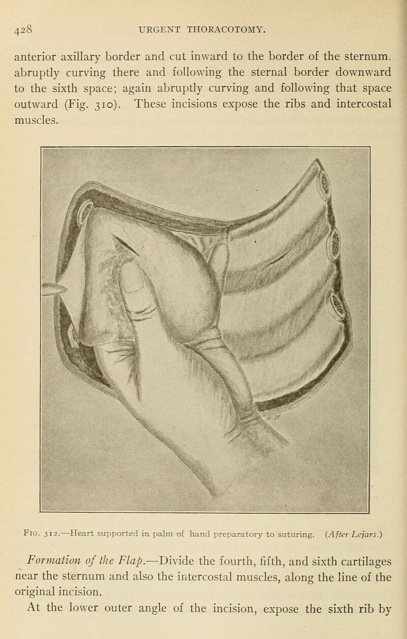 anterior axillary border and cut inward to the border of the sternum, abruptly curving there and following the sternal border downward to the sixth space; again abruptly curving and following that space outward (Fig. 310). These incisions expose the ribs and intercostal muscles. Fig. 312.—Heart supported in palm of hand preparatory to suturing. (After Lejars.) Formation of the Flap.—Divide the fourth, fifth, and sixth cartilages near the sternum and also the intercostal muscles, along the line of the original incision. At the lower outer angle of the incision, expose the sixth rib by