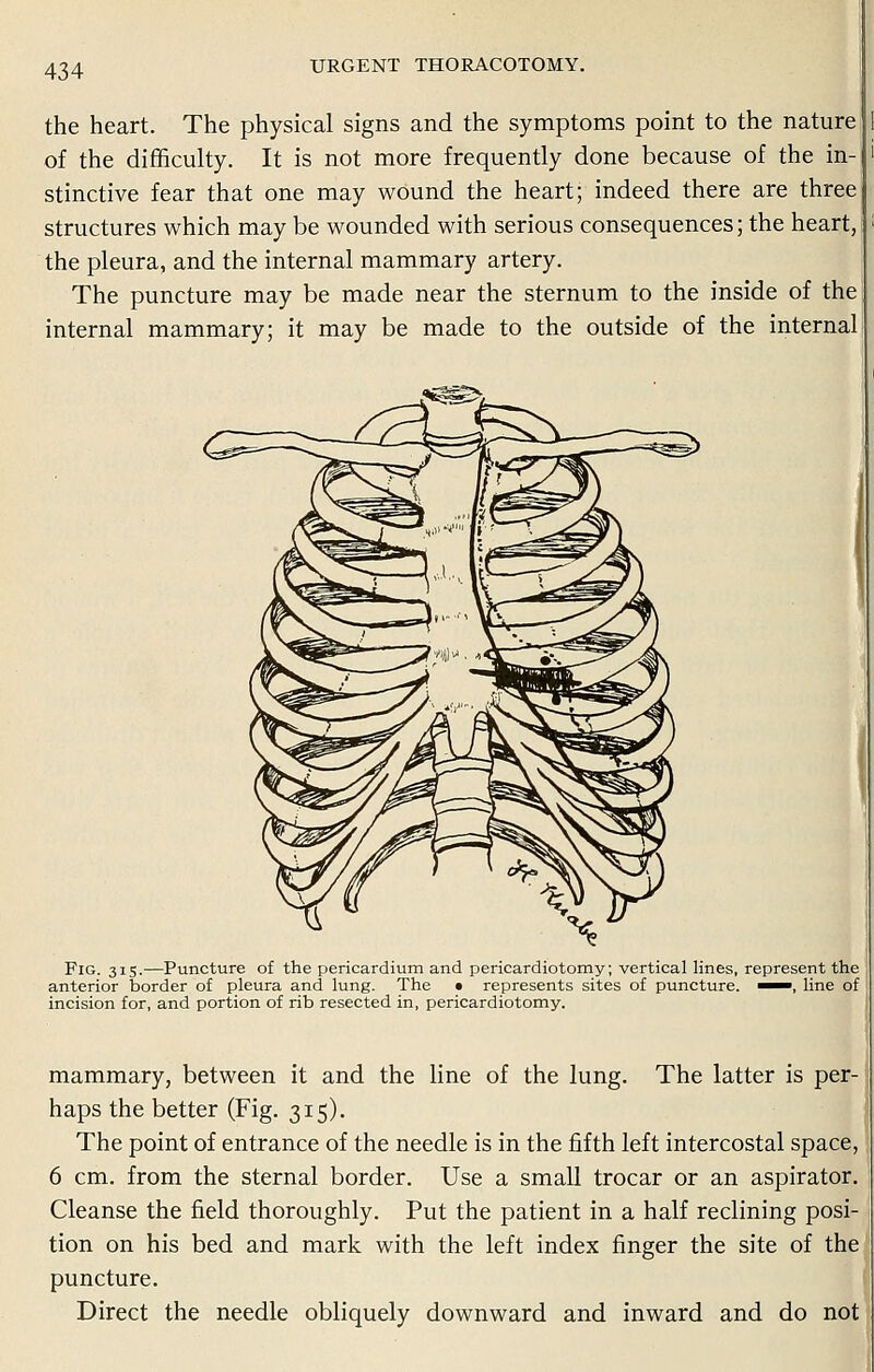 the heart. The physical signs and the symptoms point to the nature of the difficulty. It is not more frequently done because of the in- stinctive fear that one may wound the heart; indeed there are three structures which may be wounded with serious consequences; the heart, the pleura, and the internal mammary artery. The puncture may be made near the sternum to the inside of the internal mammary; it may be made to the outside of the internal Fig. 315.—Puncture of the pericardium and pericardiotomy; vertical lines, represent the anterior border of pleura and lung. The • represents sites of puncture. ^~, line of incision for, and portion of rib resected in, pericardiotomy. mammary, between it and the line of the lung. The latter is per- haps the better (Fig. 315). The point of entrance of the needle is in the fifth left intercostal space, 6 cm. from the sternal border. Use a small trocar or an aspirator. Cleanse the field thoroughly. Put the patient in a half reclining posi- tion on his bed and mark with the left index finger the site of the puncture. Direct the needle obliquely downward and inward and do not