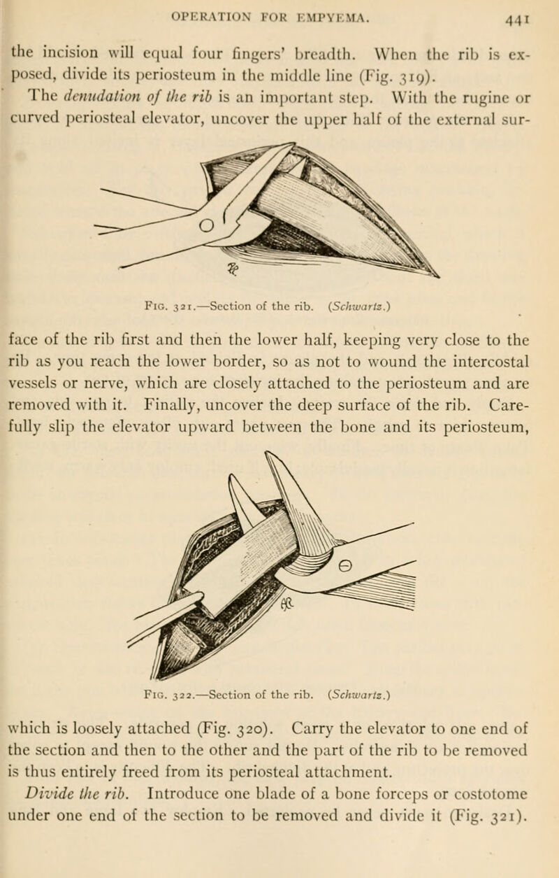 the incision will equal four fingers1 breadth. When the rib is ex- posed, divide its periosteum in the middle line (Fig. 319). The denudation of the rib is an important step. With the nigine OT curved periosteal elevator, uncover the upper half of the external sur- Fi':. 321.—Section of the rib. (Schwartz.) face of the rib first and then the lower half, keeping very close to the rib as you reach the lower border, so as not to wound the intercostal vessels or nerve, which are closely attached to the periosteum and are removed with it. Finally, uncover the deep surface of the rib. Care- fully slip the elevator upward between the bone and its periosteum, Fig. 322.—Section of the rib. (Schwartz.) which is loosely attached (Fig. 320). Carry the elevator to one end of the section and then to the other and the part of the rib to be removed is thus entirely freed from its periosteal attachment. Divide the rib. Introduce one blade of a bone forceps or costotome under one end of the section to be removed and divide it (Fig. 321).