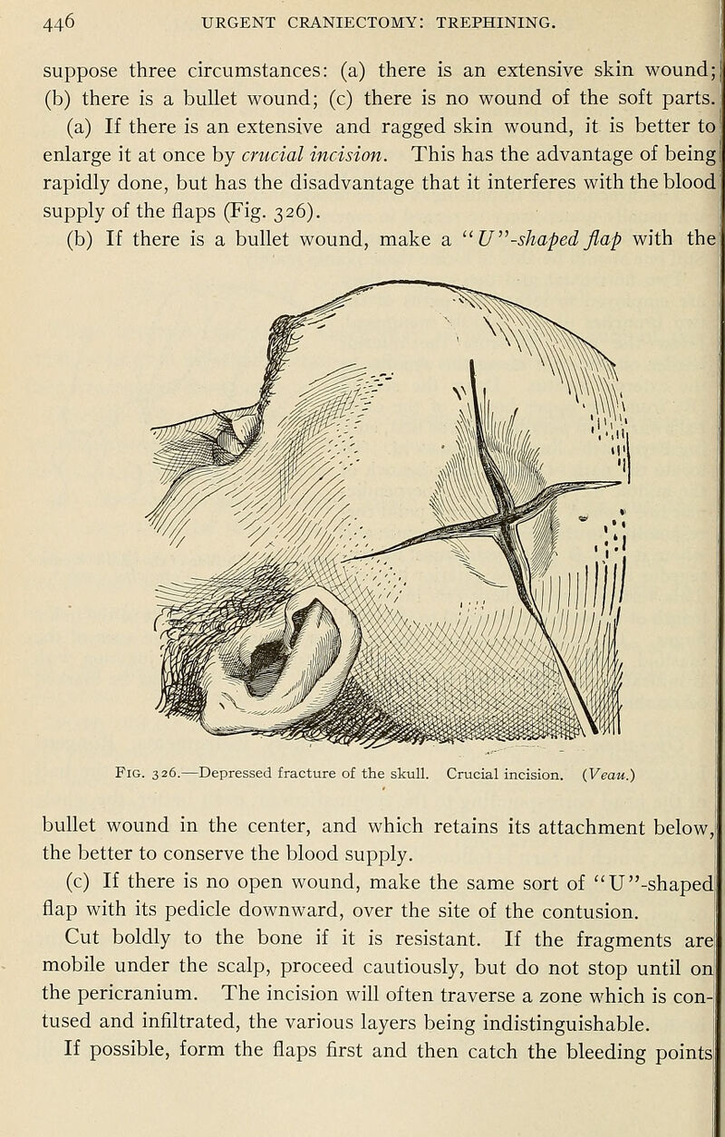 suppose three circumstances: (a) there is an extensive skin wound; (b) there is a bullet wound; (c) there is no wound of the soft parts. (a) If there is an extensive and ragged skin wound, it is better to! enlarge it at once by crucial incision. This has the advantage of being; rapidly done, but has the disadvantage that it interferes with the blood supply of the flaps (Fig. 326). (b) If there is a bullet wound, make a  U-shaped flap with the Fig. 326.—Depressed fracture of the skull. Crucial incision. (Veau.) bullet wound in the center, and which retains its attachment below the better to conserve the blood supply. (c) If there is no open wound, make the same sort of U -shaped flap with its pedicle downward, over the site of the contusion. Cut boldly to the bone if it is resistant. If the fragments are mobile under the scalp, proceed cautiously, but do not stop until on the pericranium. The incision will often traverse a zone which is con- tused and infiltrated, the various layers being indistinguishable. If possible, form the flaps first and then catch the bleeding points