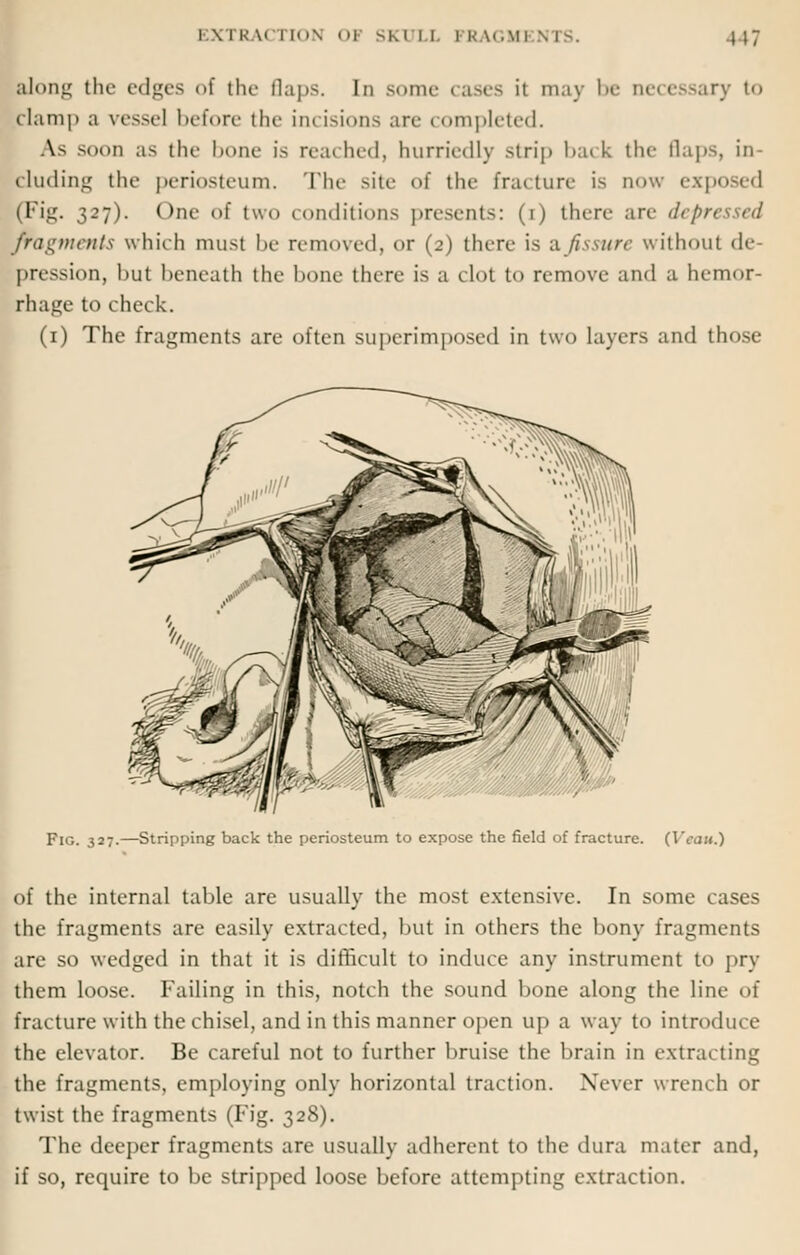 EXTRA! riON mi SKI I I \ \< u.mi 117 along tin- edges <•! tlu- tlaps. In some cases it may be necessary to clamp a vessel In-fore tin- incisions are completed. As SOOD as the lume is reached, hurriedly strip back the flaps, in- eluding the periosteum. The site of the fracture is now ex] (Fig. 327). One of two conditions presents: (1) there are d<: ■ fragments which must be removed, or (2) there is a fissure without de- pression, but beneath the hone there is a clot to remove and a hemor- rhage to check. (1) The fragments are often superimposed in two layers and those Fig. 327.—Stripping back the periosteum to expose the field of fracture. (Veau.) of the internal table are usually the most extensive. In some cases the fragments are easily extracted, but in others the bony fragments are so wedged in that it is difficult to induce any instrument to pry them loose. Failing in this, notch the sound bone along the line of fracture with the chisel, and in this manner open up a way to introduce the elevator. Be careful not to further bruise the brain in extracting the fragments, employing only horizontal traction. Never wrench or twist the fragments (Fig. 328). The deeper fragments are usually adherent to the dura mater and, if so, require to be stripped loose before attempting extraction.