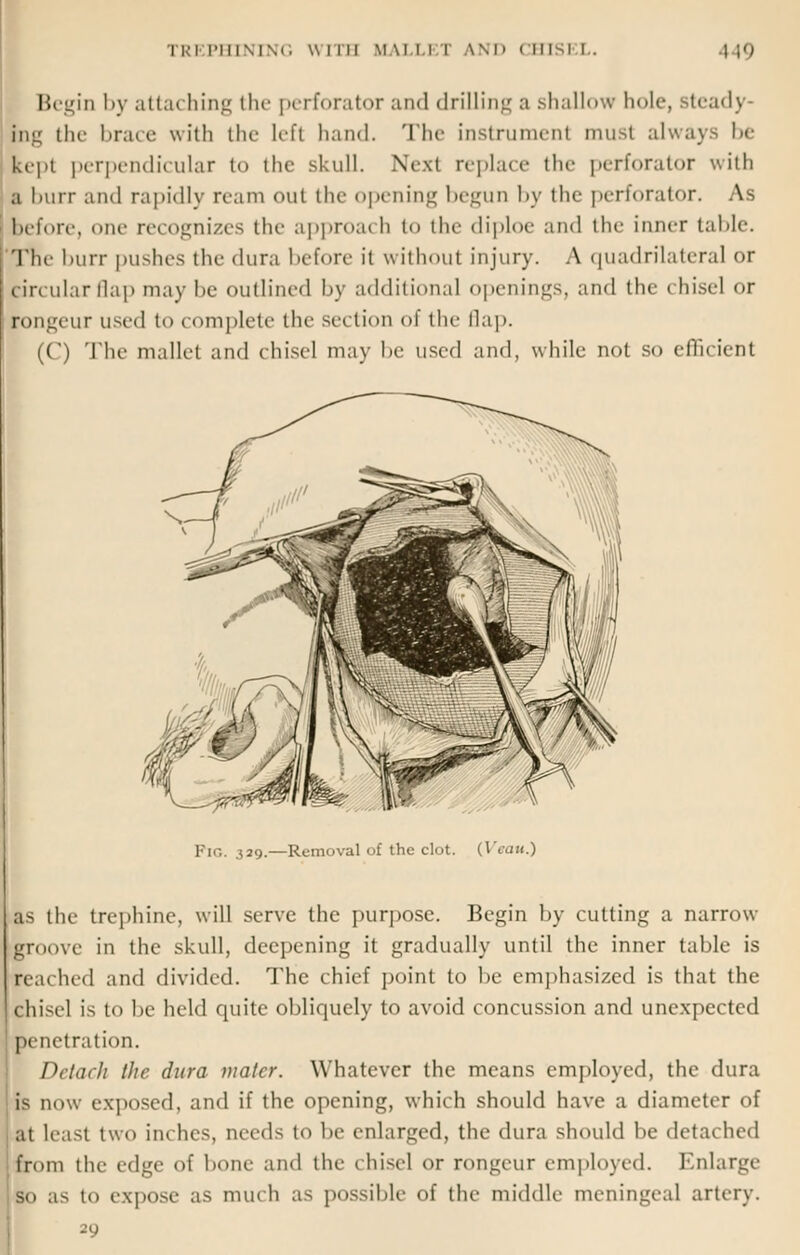 TREPHINING Willi MALLEI VND CHISE1 i 19 Begin by attaching the perforator and drilling a shallow hole, Bteady- ktg the brace with the left hand. The instrument must always be lept perpendicular to the skull. Next replace the perforator with a burr and rapidly ream oul the opening begun by the perforator. As before, one recognizes the approach to the diploe and the inner table. Tin- burr pushes the dura before it without injury. A quadrilateral or circular Qap may be outlined by additional openings, and the chisel or |ongeur used to complete the section of the Qap. ((') The mallet and chisel may be used and, while not so efficient Pig. 329.—Removal of the clot. (Veau.) as the trephine, will serve the purpose. Begin by cutting a narrow groove in the skull, deepening it gradually until the inner table is bached and divided. The chief point to be emphasized is that the chisel is to be held quite obliquely to avoid concussion and unexpected penetration. Detach the dura malcr. Whatever the means employed, the dura is now exposed, and if the opening, which should have a diameter of at least two inches, needs to be enlarged, the dura should be deta< bed from the edge of bone and the chisel or rongeur employed. Enlarge so as to expose as nun h as possible of the middle meningeal artery. 29