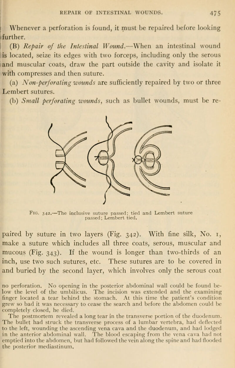 Whenever a perforation is found, it must be repaired before looking further. (H) Repair of the Intestinal Wound. When an intestinal won no1 is located, seize its edges with two forceps, including only the serous and muscular coats, draw the part outside the cavity and isolate it with compresses and then suture. (a) Non-perforating wounds are sufficiently repaired by two or three Lembert sutures. (I)) Small perforating wounds, such as bullet wounds, must be re- Fig. 342.—The inclusive suture passed; tied and Lembert suture passeil; Lembert tied. paired by suture in two layers (Fig. 342). With fine silk, No. 1, make a suture which includes all three coats, serous, muscular and mucous (Fig. 343). If the wound is longer than two-thirds of an inch, use two such sutures, etc. These sutures are to be covered in and buried by the second layer, which involves only the serous coat no perforation. No opening in the posterior abdominal wall could be found be- low the level of the umbilicus. The incision was extended and the examining finger located a tear behind the stomach. At this time the patient's condition grew so bad it was necessary to cease the search and before the abdomen could be Completely closed, he died. The postmortem revealed a long tear in the transverse portion of the duodenum. Tlie bullet had struck the transverse process of a lumbar vertebra, had deflected to the left, wounding the ascending vena cava and the duodenum, and had lodged in the anterior abdominal wall. The Mood escaping from the vena cava had not emptied into the abdomen, but had followed the vein along the spine and had flooded the posterior mediastinum.